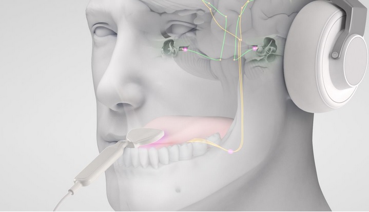 Ce dispositif de neuromodulation bimodale comprend des écouteurs et un petit réseau d'électrodes qui stimule la langue (Visuel Neuromod Devices Limited)