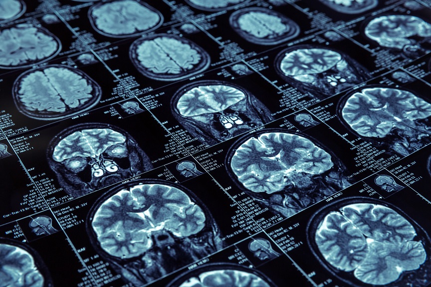 Une plate-forme d'intelligence artificielle s'avère capable de détecter toute une gamme de maladies neurodégénératives dans des échantillons de tissus cérébraux humains, notamment la maladie d'Alzheimer et l'encéphalopathie traumatique chronique. Une plate-forme d'intelligence artificielle s'avère capable de détecter toute une gamme de maladies neurodégénératives dans des échantillons de tissus cérébraux humains, notamment la maladie d'Alzheimer et l'encéphalopathie traumatique chronique.