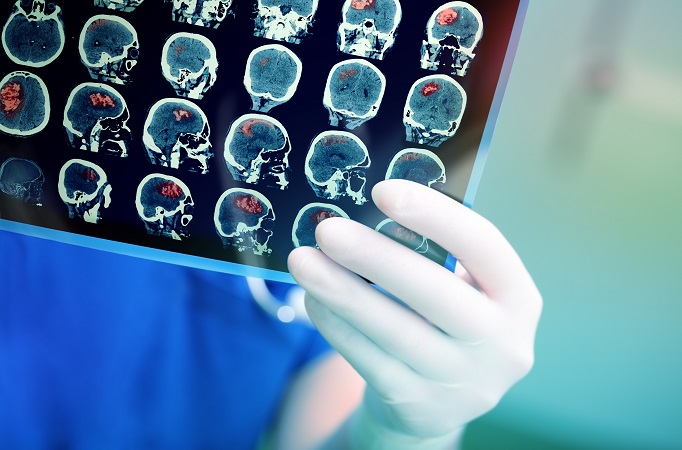L'AVC est généralement causé par un caillot de sang dans le cerveau et peut entraîner la mort en quelques minutes. L'AVC est généralement causé par un caillot de sang dans le cerveau et peut entraîner la mort en quelques minutes.