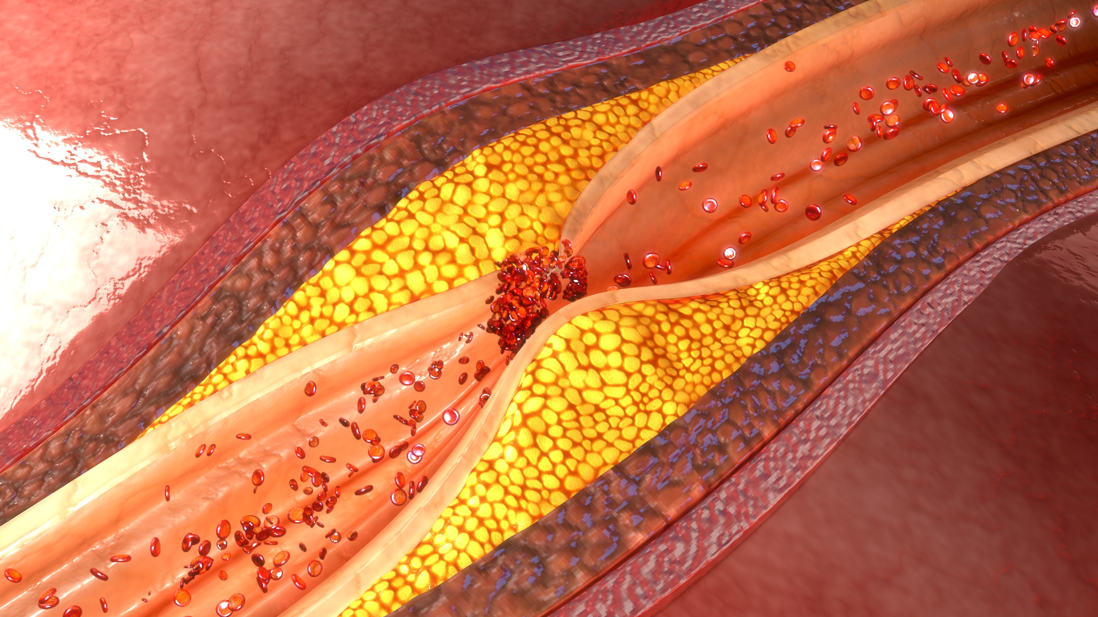 La calcification vasculaire et l’accumulation de cholestérol contribuent au développement de l’athéroscléros