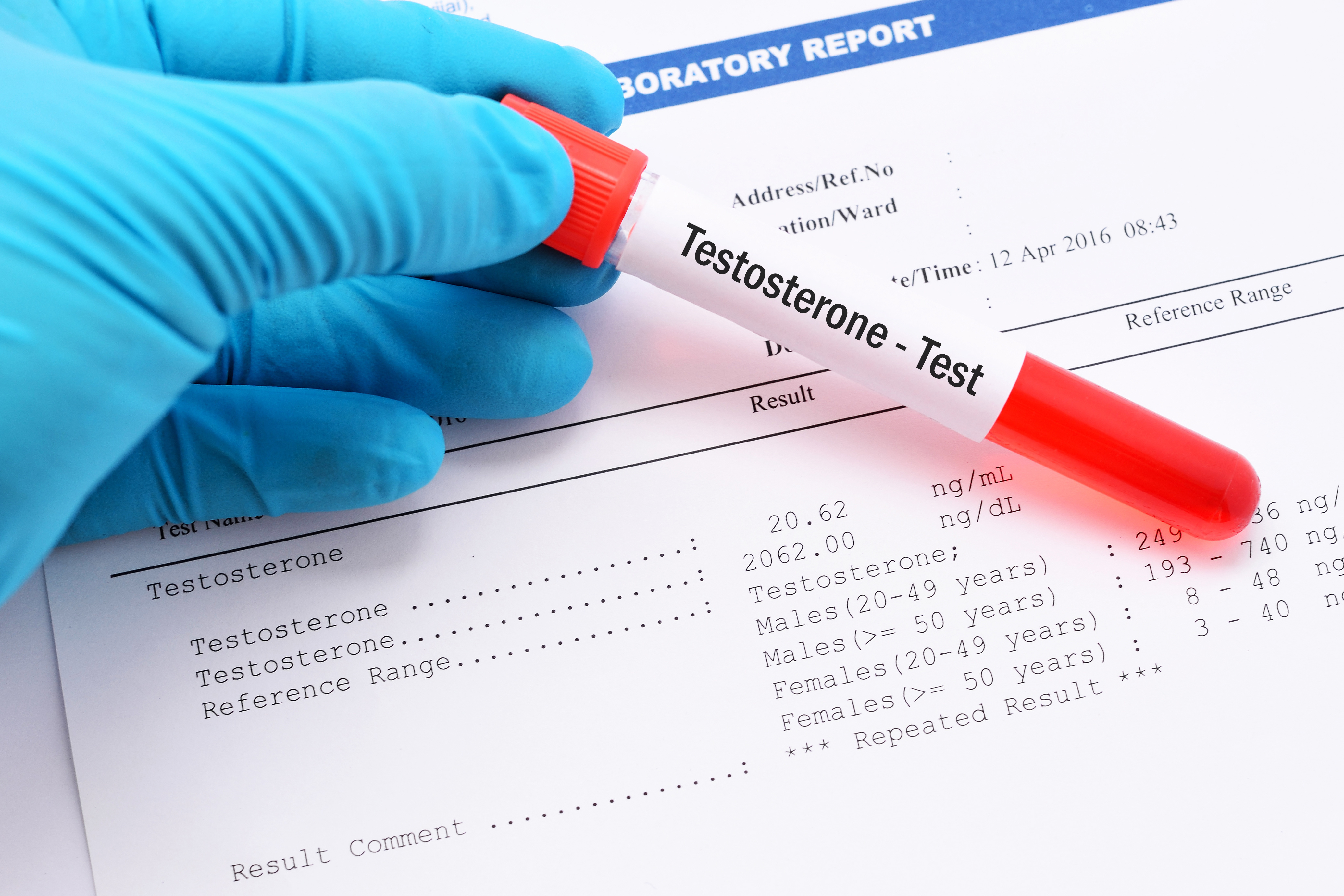 En synthèse, la testostérone permet de réduire la stéatose hépatique et de faire d’une pierre deux coups chez ce groupe de patients atteints à la fois d'hypogonadisme et de troubles métaboliques (Visuel Adobe Stock 121379406) En synthèse, la testostérone permet de réduire la stéatose hépatique et de faire d’une pierre deux coups chez ce groupe de patients atteints à la fois d'hypogonadisme et de troubles métaboliques (Visuel Adobe Stock 121379406)