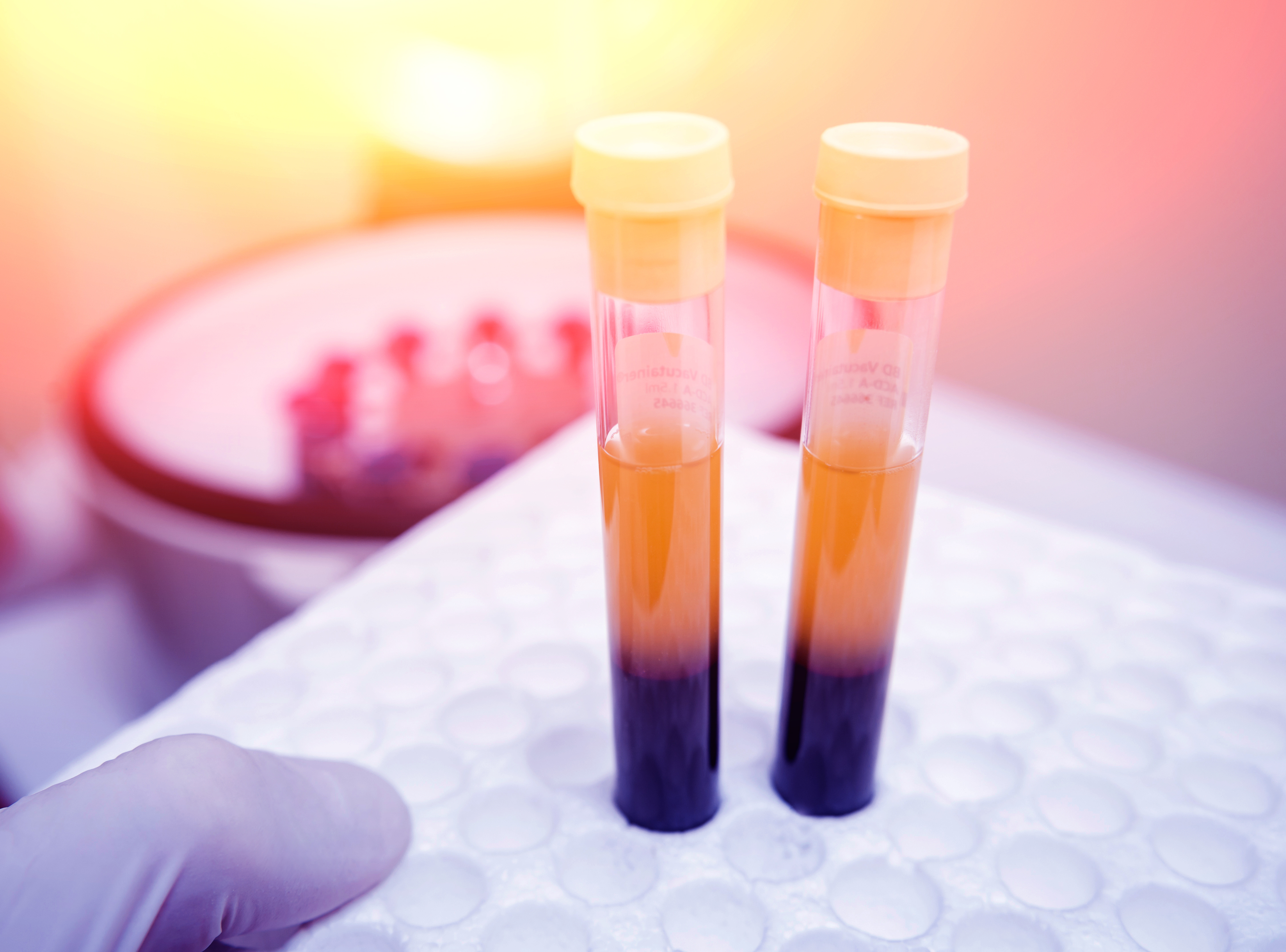 La biopsie liquide effectuée sur des échantillons de sérum sanguins permet aujourd’hui une détection plus précoce de la récidive du cancer et apporte des données précieuses, complémentaires à celles des diagnostics standards (Visuel Adobe Stock 143663706)