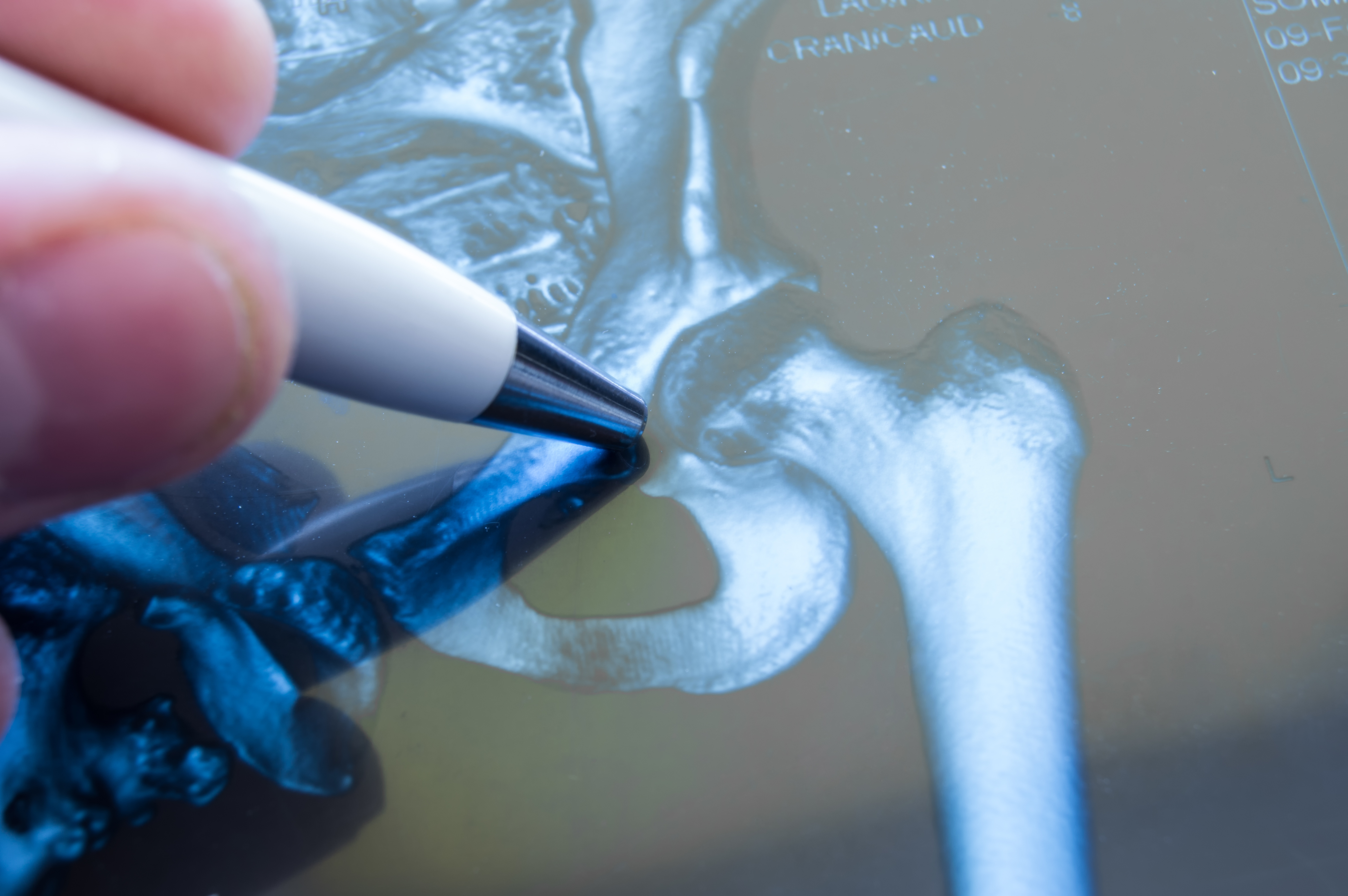 L'arthroplastie de la hanche est-elle toujours envisageable et sans danger pour les patients âgés de 90 ans ? (Visuel Adobe Stock 146660430)