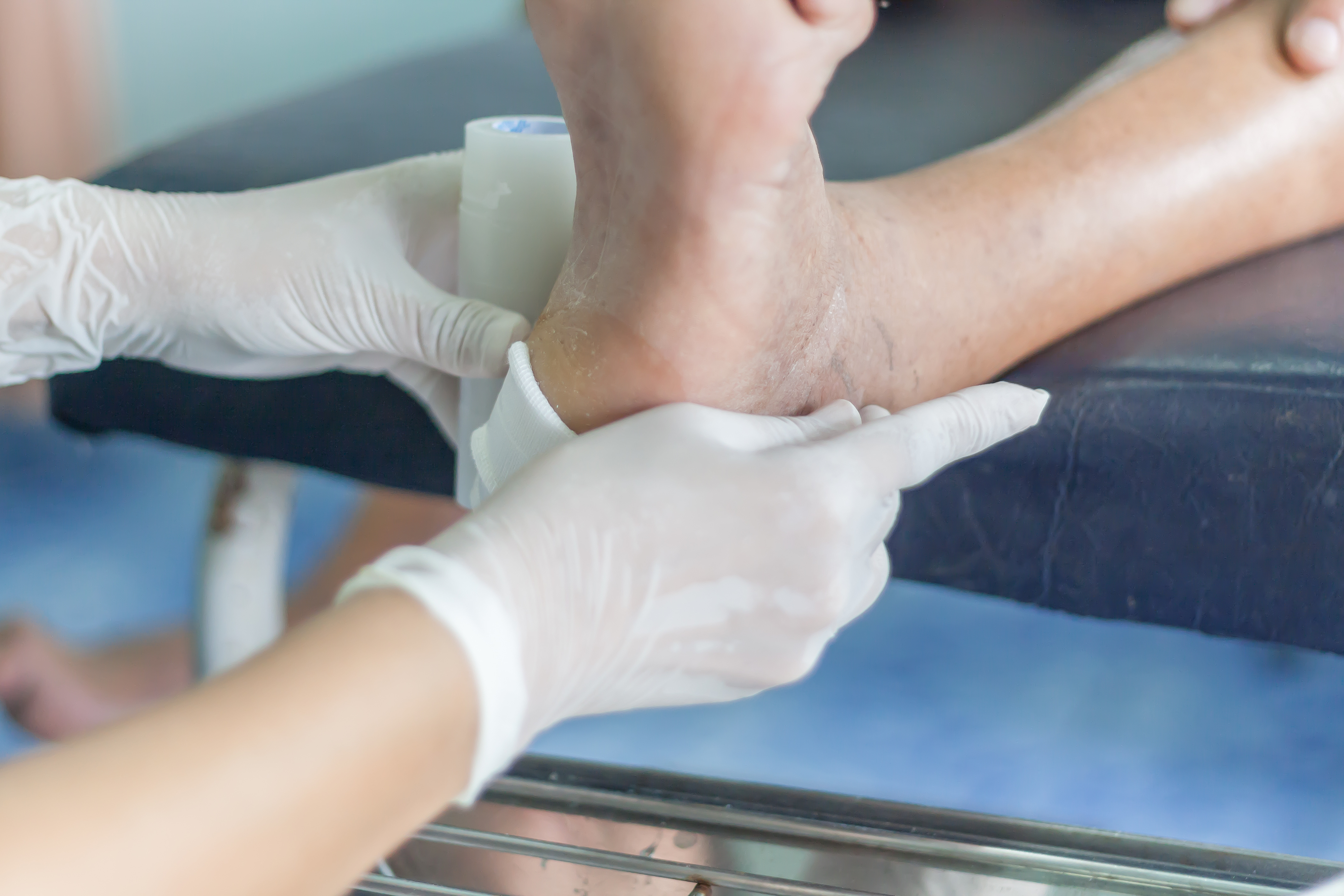 La mise oeuvre de services de soins spécialisés des ulcères du pied diabétique a permis, en Belgique, d'assurer une bonne gestion de ces plaies durant la pandémie (Visuel Adobe Stock 165767373) La mise oeuvre de services de soins spécialisés des ulcères du pied diabétique a permis, en Belgique, d'assurer une bonne gestion de ces plaies durant la pandémie (Visuel Adobe Stock 165767373)