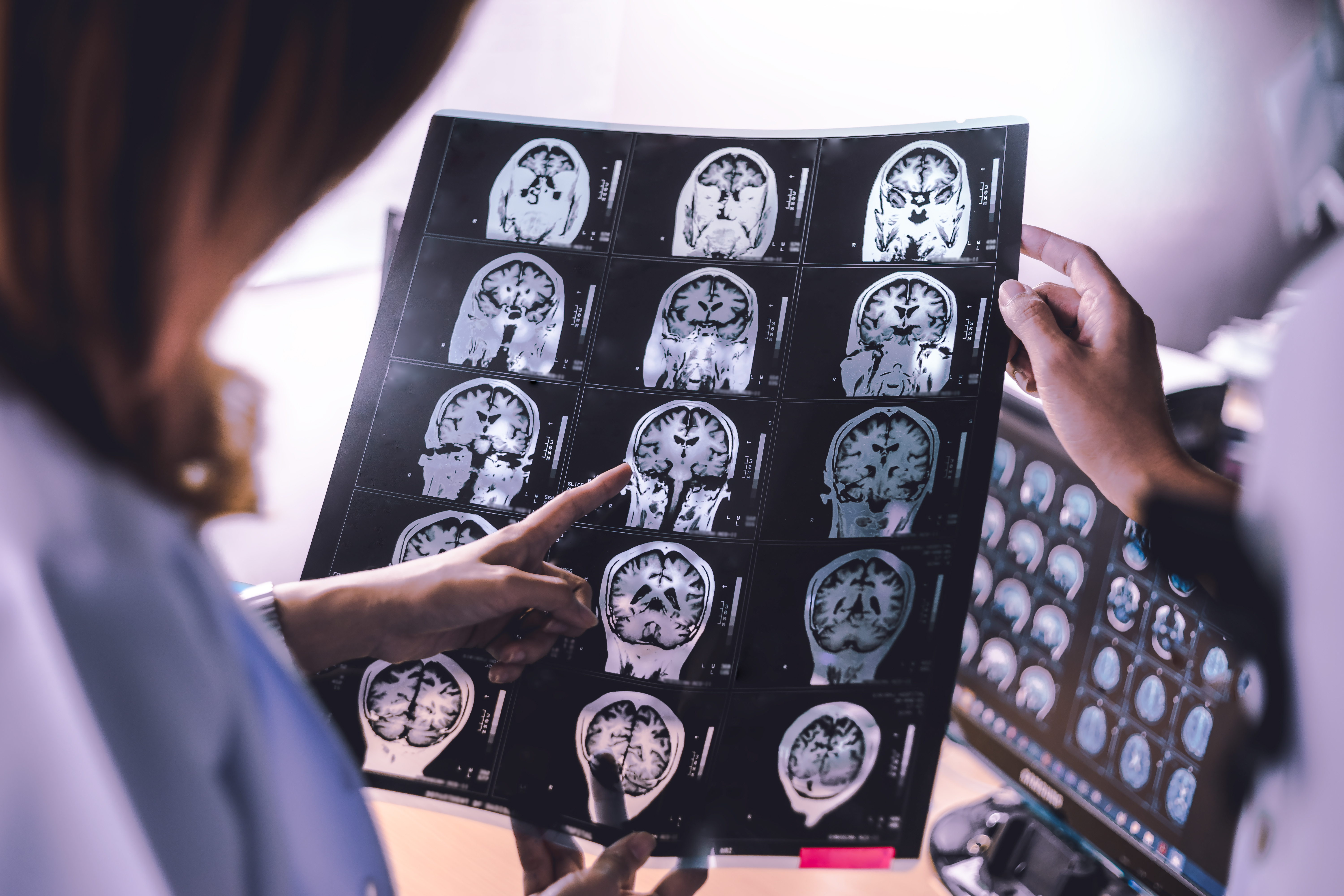 On l’appelle le centre de la mémoire, mais l'hippocampe est aussi la première zone touchée par la neurodégénérescence. (Visuel Adobe Stock 170691498) 