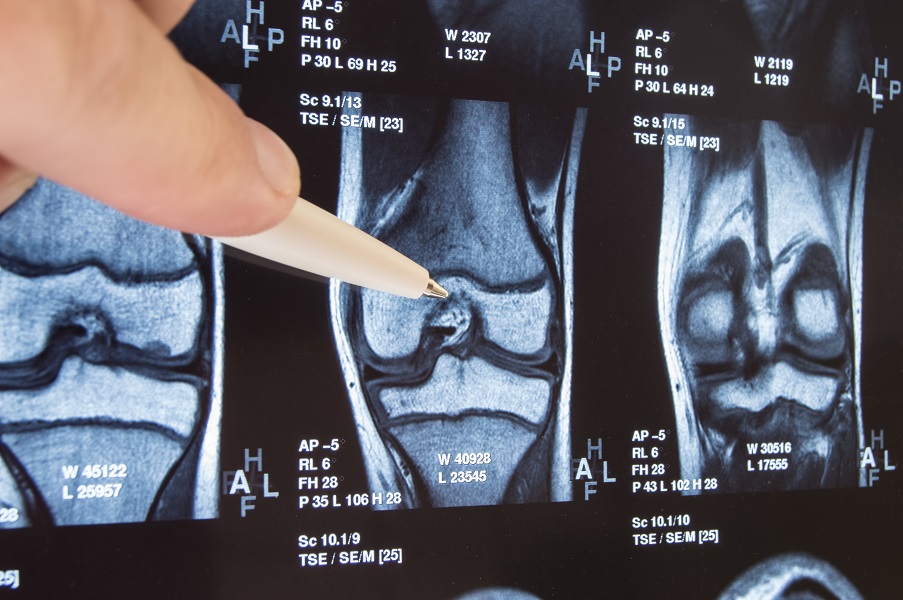  les cellules souches recueillies dans la moelle osseuse du patient s’avèrent ici un traitement prometteur de l'arthrose du genou en raison de leur capacité à régénérer le cartilage endommagé. 