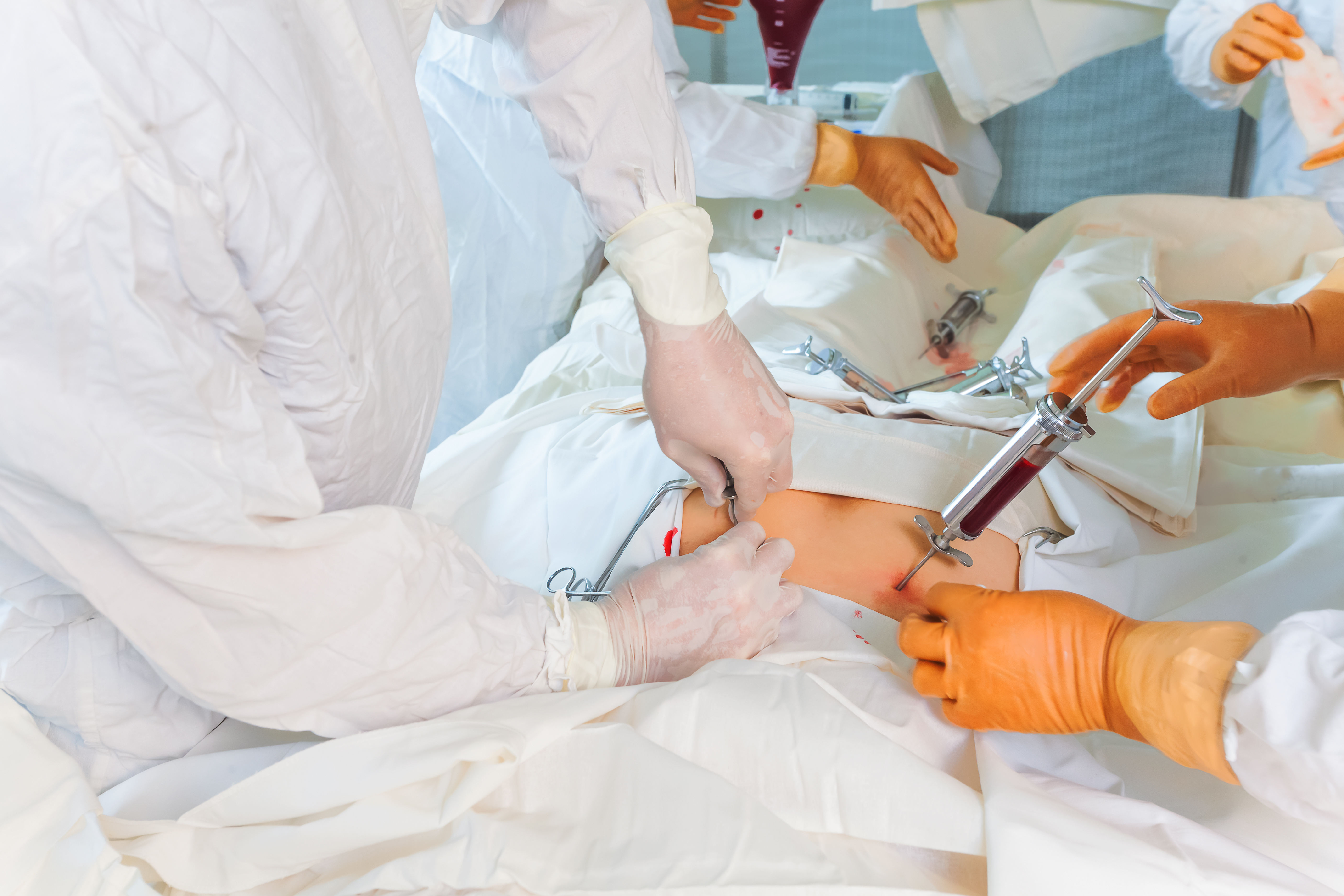 Les greffes de moelle osseuse sont des traitements vitaux pour les patients atteints de cancers du sang et d'autres maladies. Les greffes de moelle osseuse sont des traitements vitaux pour les patients atteints de cancers du sang et d'autres maladies.