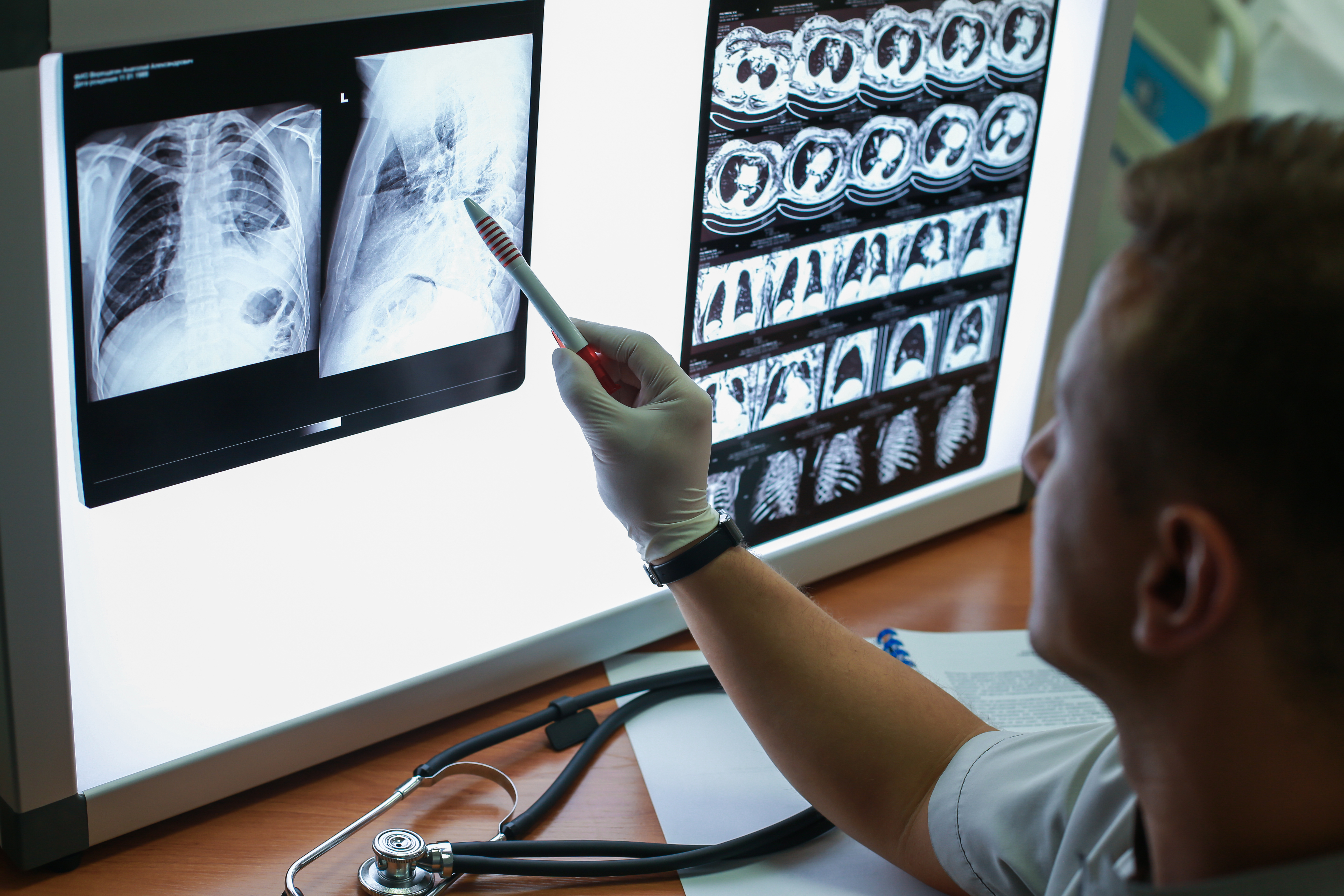 Environ 20 à 40 % des adultes présentant des symptômes de maladie pulmonaire obstructive chronique (MPOC) mais qui ne sont pas diagnostiqués avec cette maladie, notamment des fumeurs, utilisent des inhalateurs de bronchodilatateurs sur une longue durée (Visuel Adobe Stock 181476510) Environ 20 à 40 % des adultes présentant des symptômes de maladie pulmonaire obstructive chronique (MPOC) mais qui ne sont pas diagnostiqués avec cette maladie, notamment des fumeurs, utilisent des inhalateurs de bronchodilatateurs sur une longue durée (Visuel Adobe Stock 181476510)