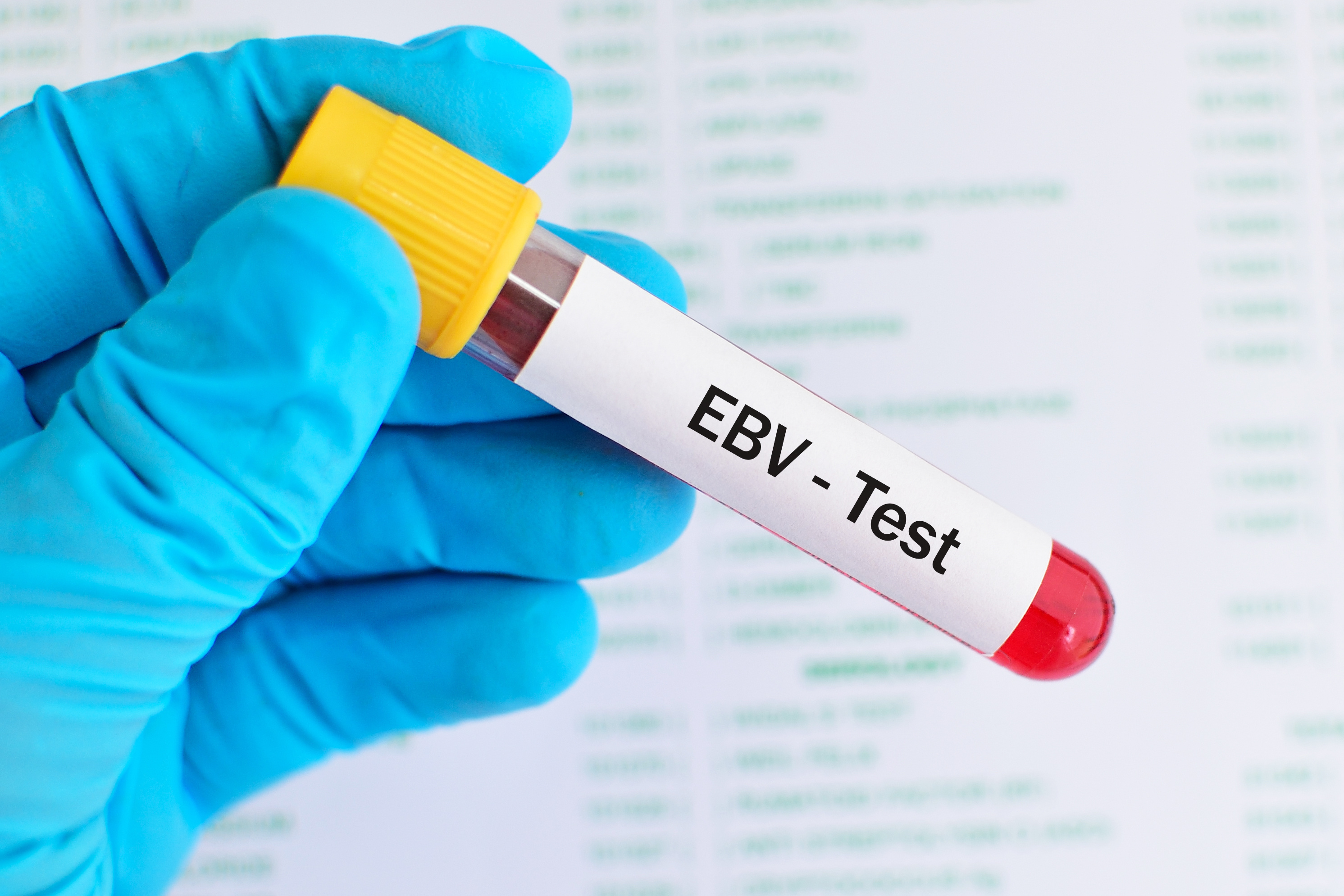 La mononucléose infectieuse également appelée « fièvre glandulaire » -en raison du gonflement des ganglions lymphatiques- est provoquée par le virus d'Epstein-Barr (VEB), un type courant de virus de l’herpès, qui affecte à peu près tout le monde au cours de la vie (Visuel Adobe Stock 198065169) La mononucléose infectieuse également appelée « fièvre glandulaire » -en raison du gonflement des ganglions lymphatiques- est provoquée par le virus d'Epstein-Barr (VEB), un type courant de virus de l’herpès, qui affecte à peu près tout le monde au cours de la vie (Visuel Adobe Stock 198065169)