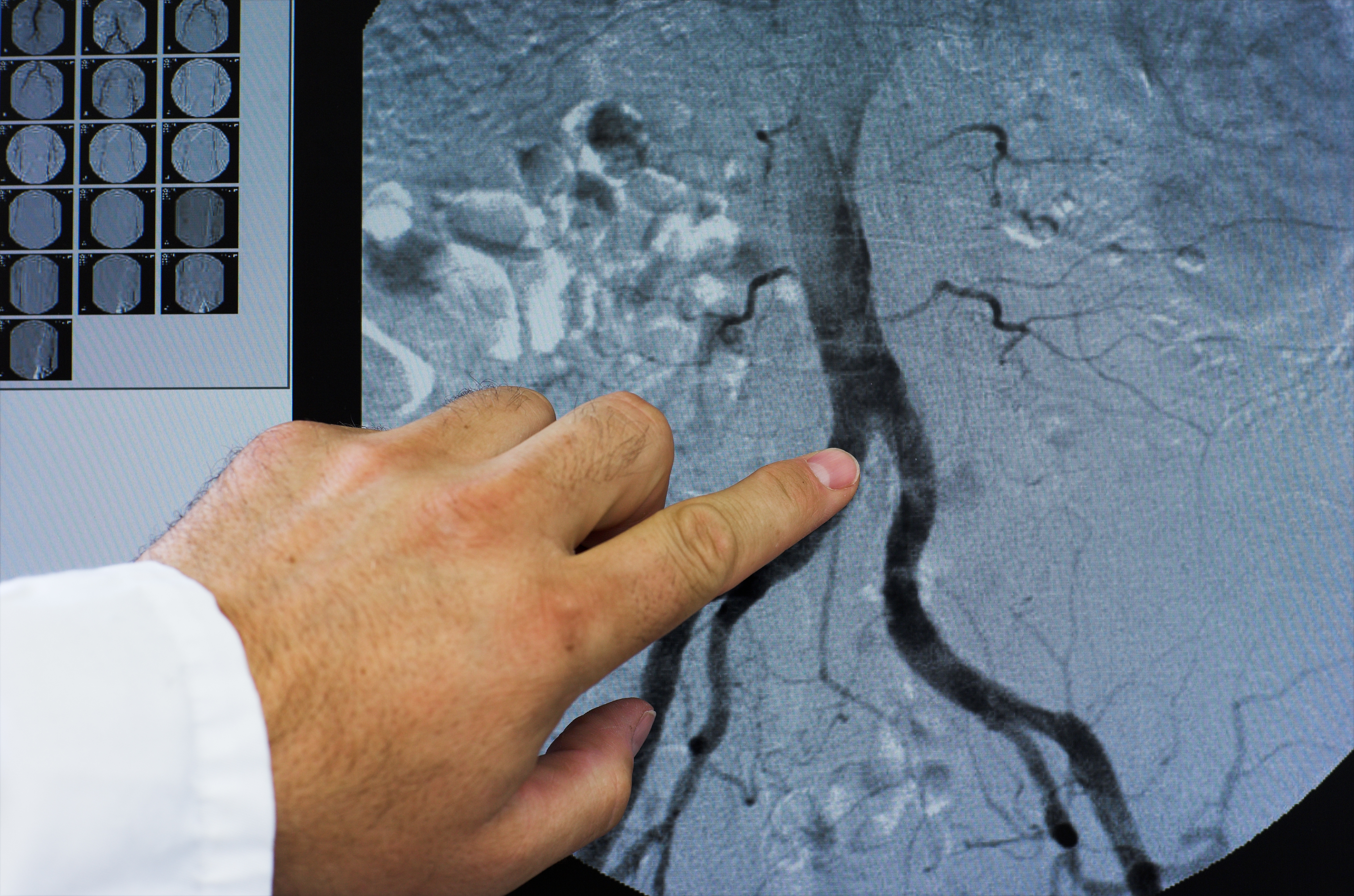 La tomodensitométrie (ou CT-scan) est confirmée comme une alternative non invasive au cathétérisme cardiaque – ou angiographie coronaire (ou coronarographie), un test diagnostique qui suppose l'insertion d'un cathéter (Visuel Adobe Stock 19839128). 