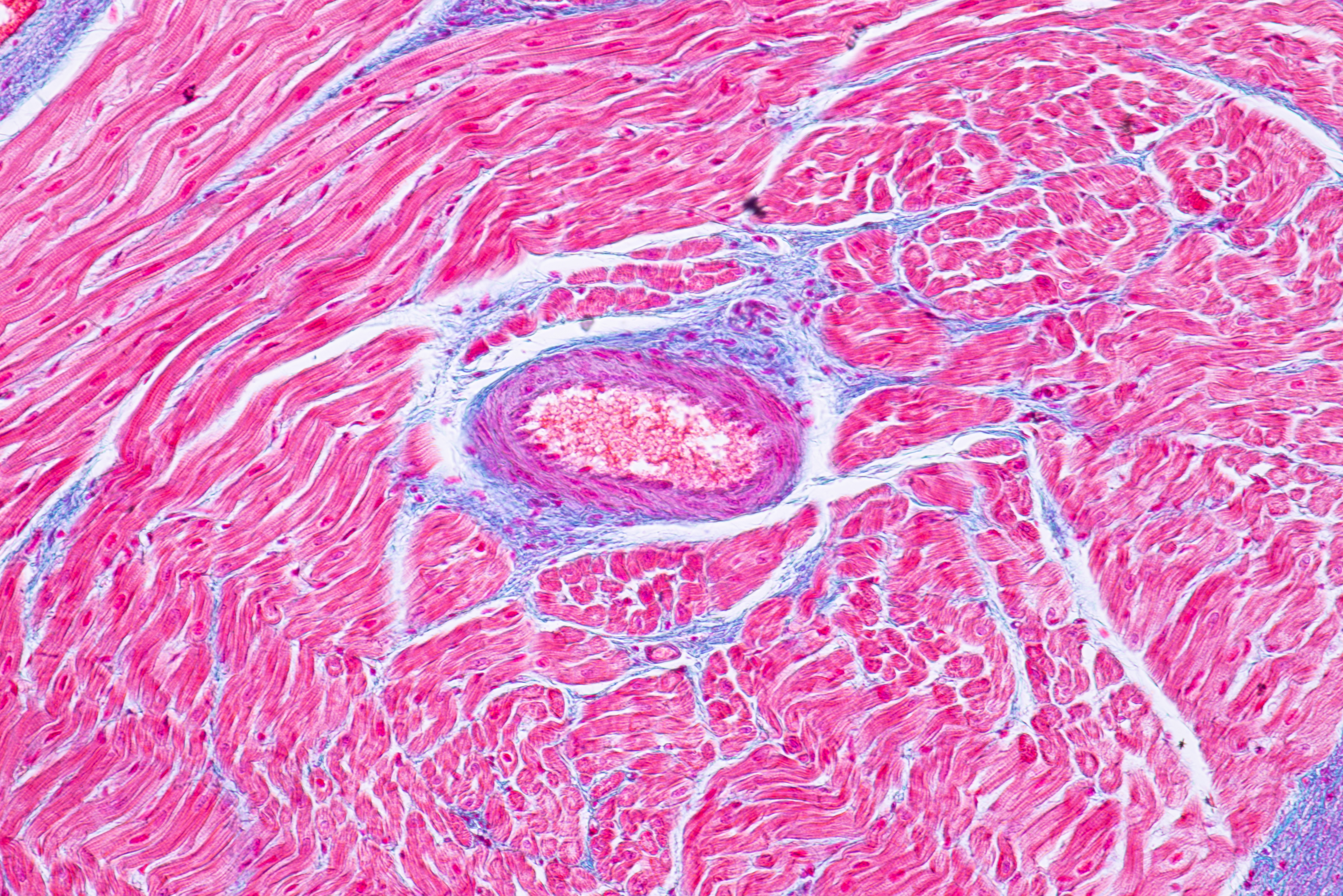 En cause, des effets directs sur les cardiomyocytes, les cellules musculaires du cœur (Visuel Adobe stock 201139568)