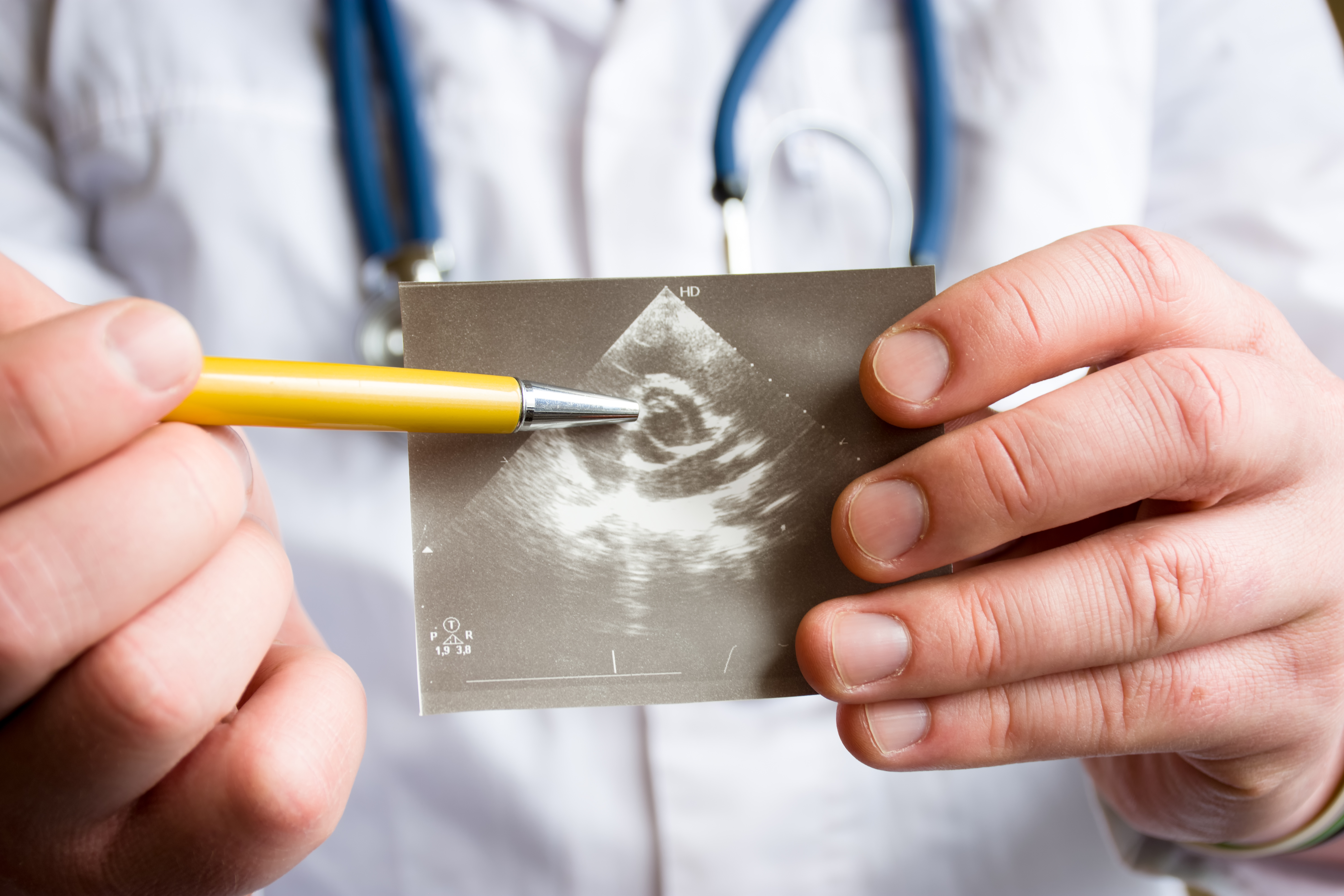 Parmi les maladies chroniques bien associées à la pollution de l’air, la maladie cardiovasculaire, dont le risque s’accroît déjà avec l’exposition prénatale (Visuel Adobe stock 207108411)