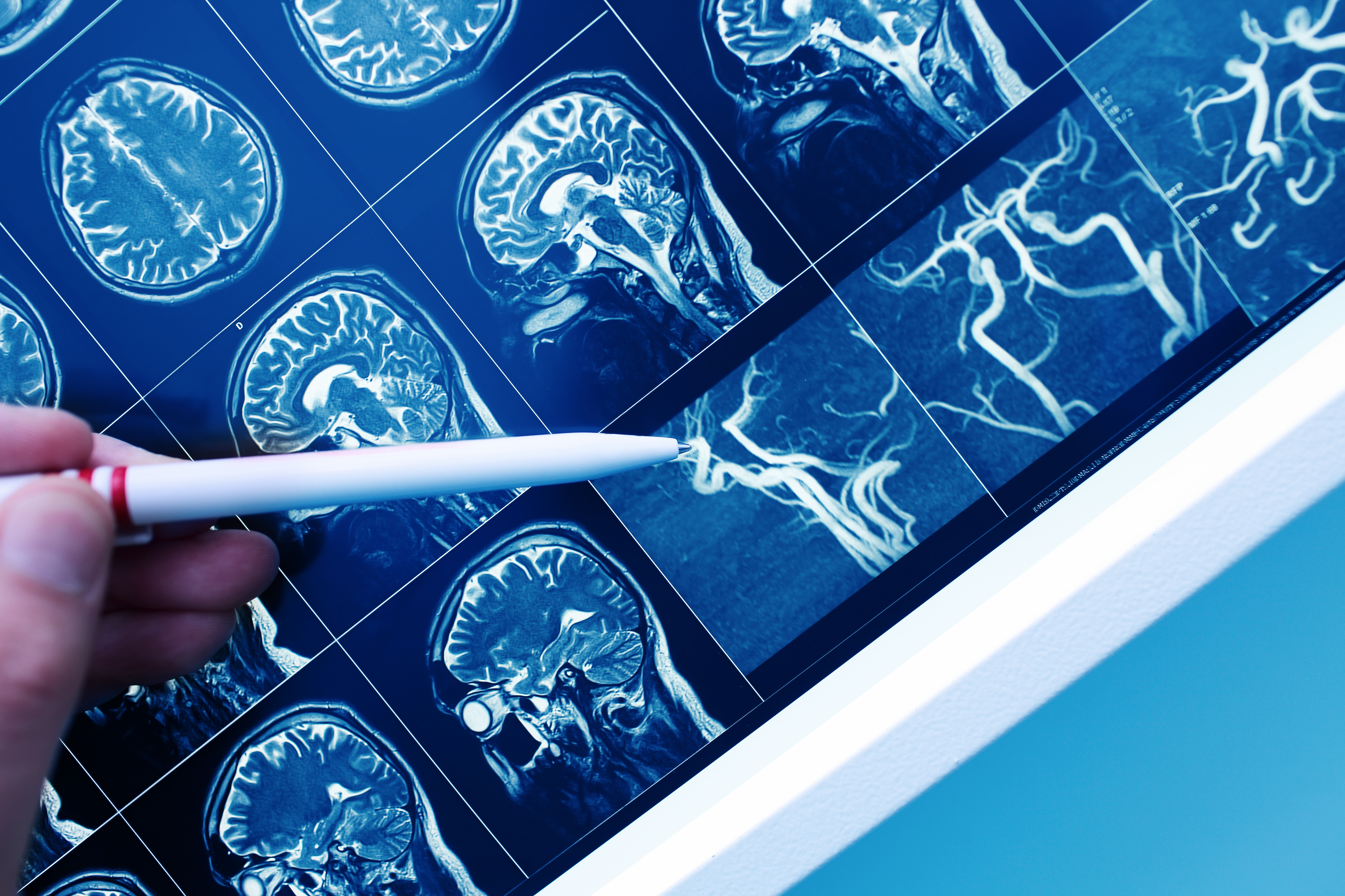 La santé cérébrovasculaire est un facteur documenté de risque de démence, en particulier de démence vasculaire (Visuel Adobe Stock 209246282)
