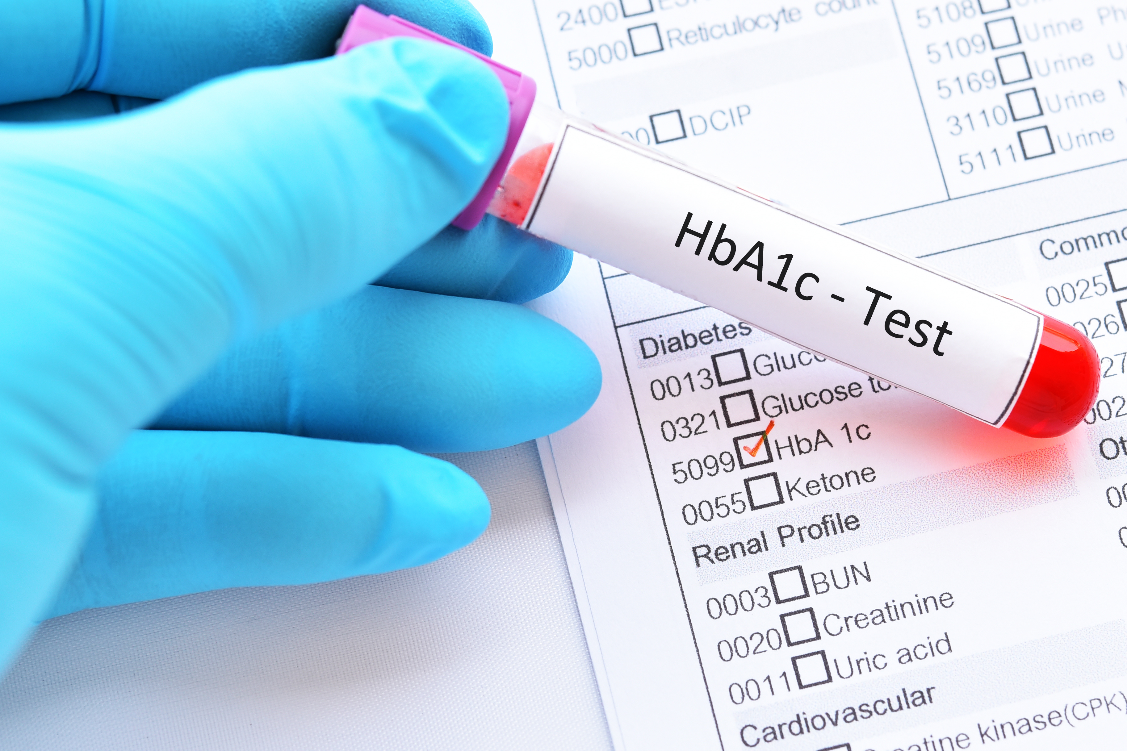 La durée de vie avec une hémoglobine glyquée (HbA1c) -une métrique standard de la glycémie- dans la plage recommandée est bien un facteur de réduction du risque de démence chez les personnes âgées diabétiques (Visuel Adobe Stock 211144940) La durée de vie avec une hémoglobine glyquée (HbA1c) -une métrique standard de la glycémie- dans la plage recommandée est bien un facteur de réduction du risque de démence chez les personnes âgées diabétiques (Visuel Adobe Stock 211144940)