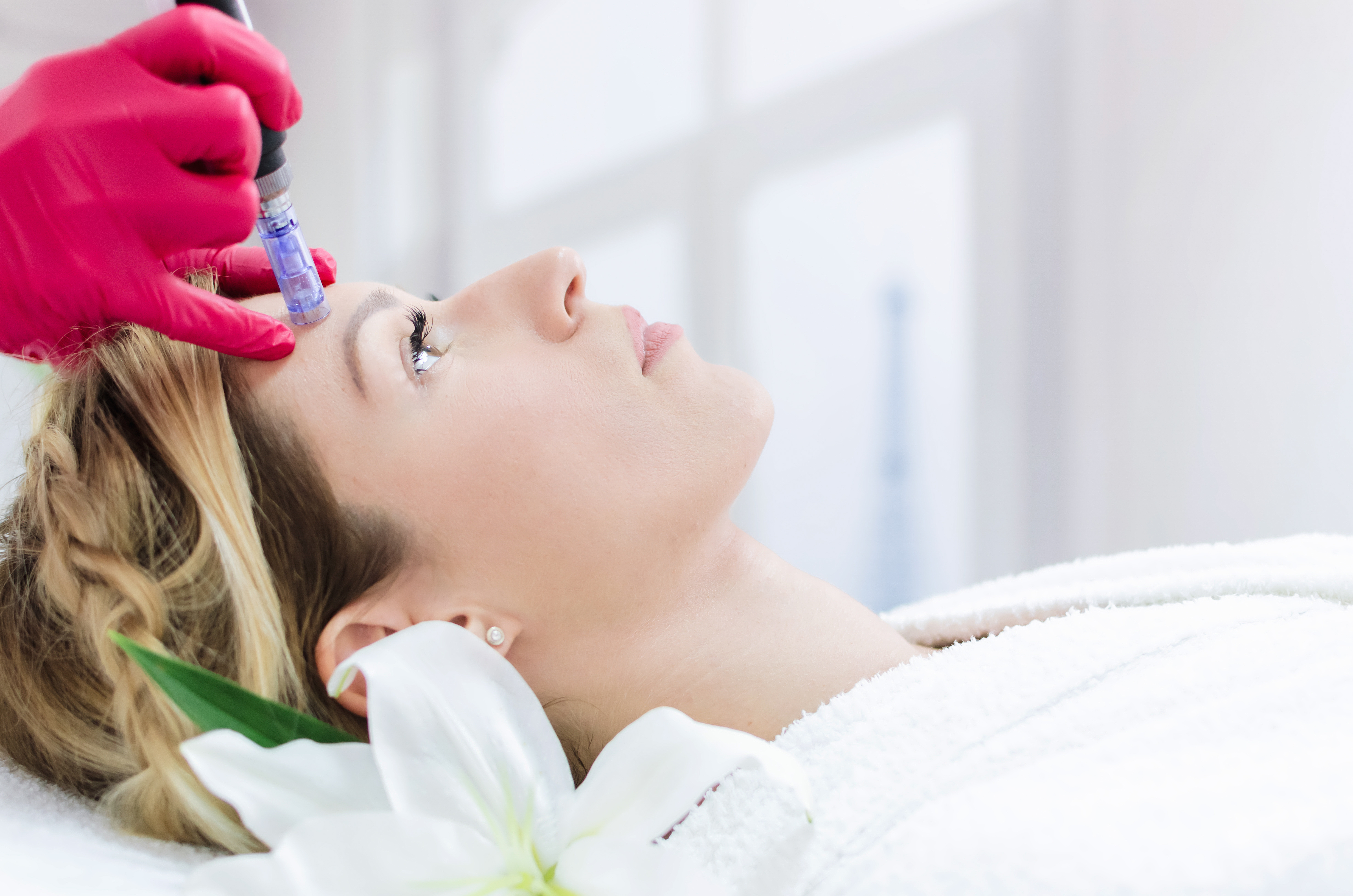 Le microneedling, ou soin cutané à micro-aiguilles améliore l'apparence des cicatrices d'acné Le microneedling, ou soin cutané à micro-aiguilles améliore l'apparence des cicatrices d'acné