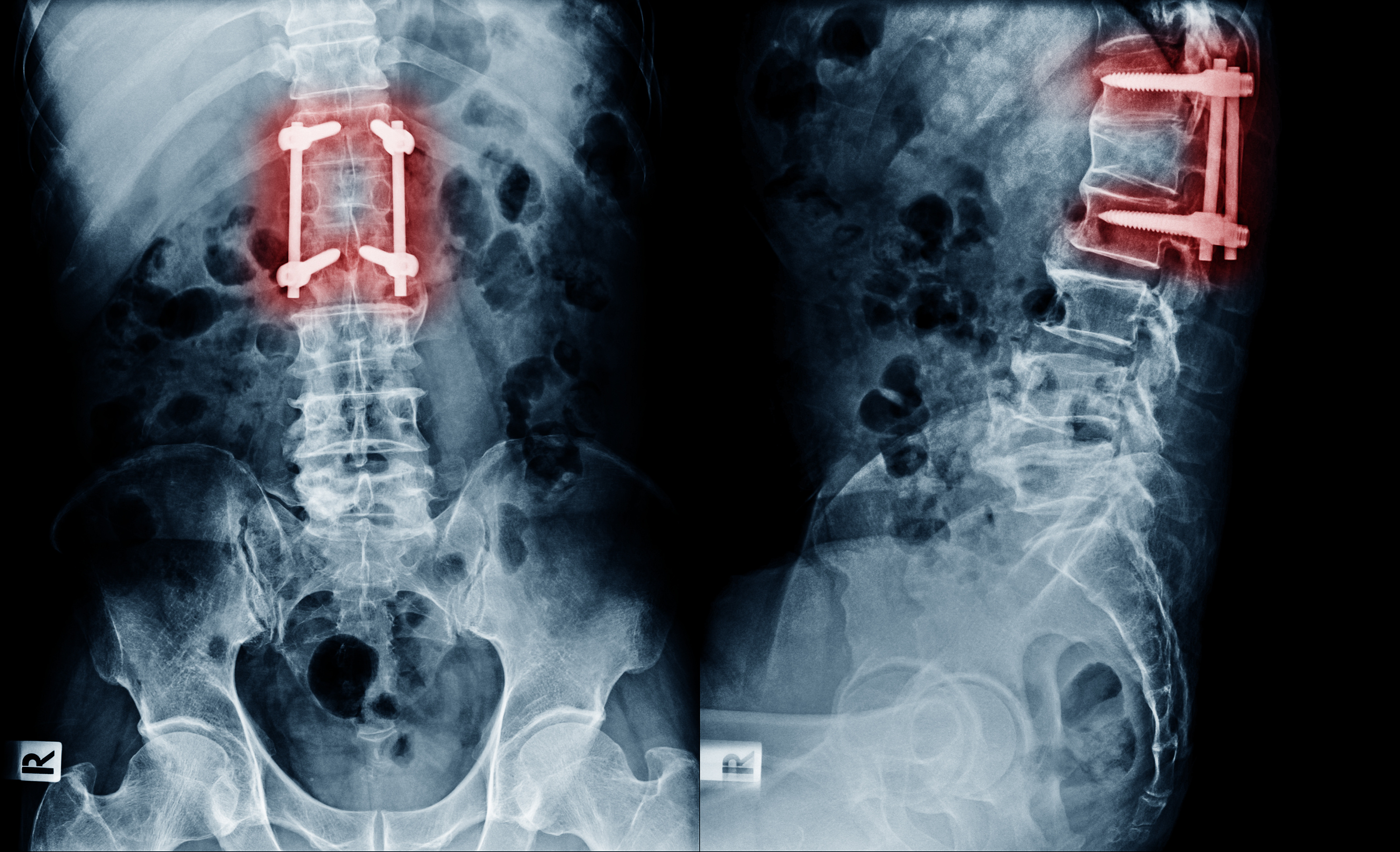 Des implants intelligents, auto-alimentés permettent de surveiller la guérison de lésions et troubles de la colonne vertébrale (Visuel Adobe stock 214542321)