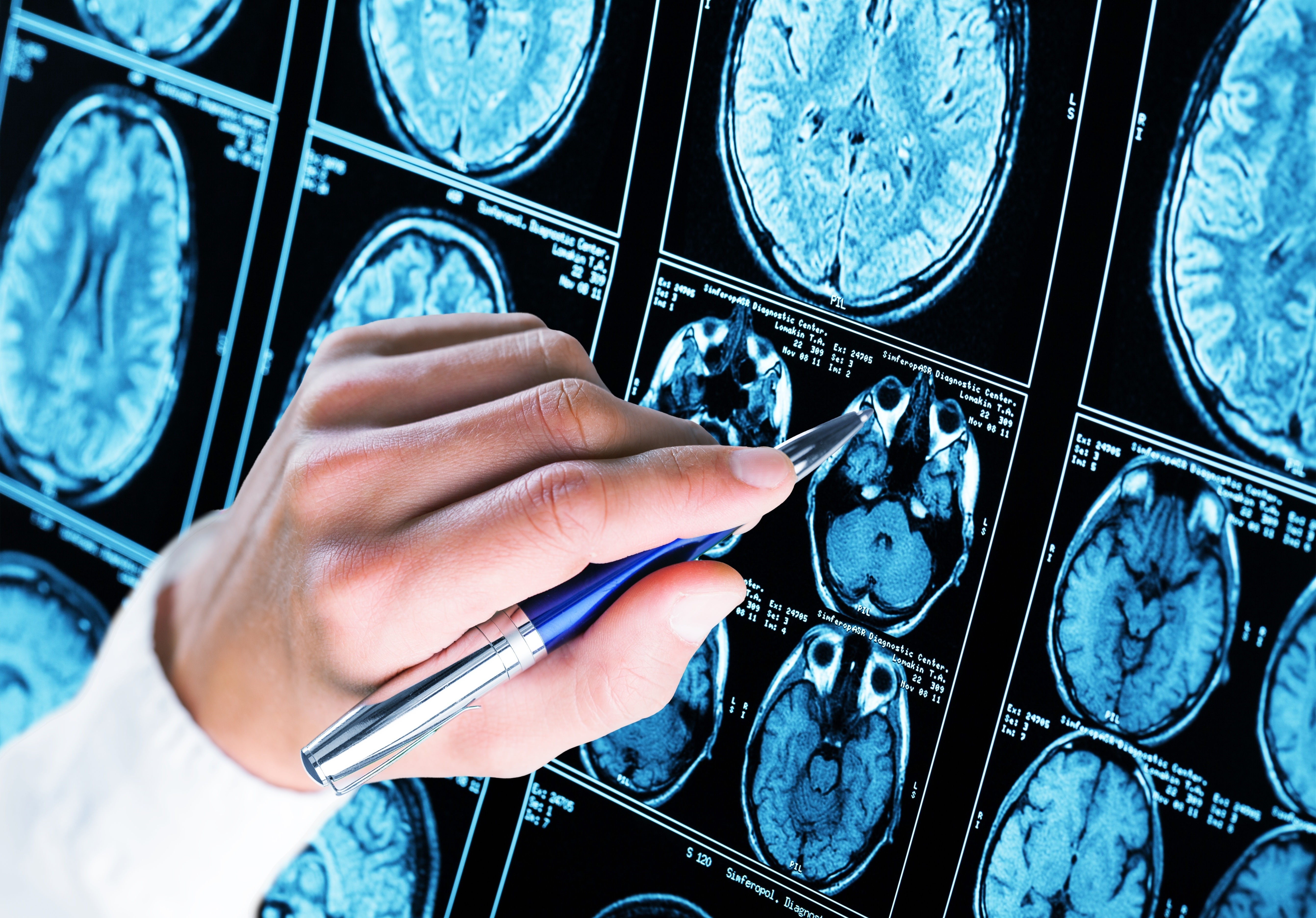 Ces neuroscientifiques viennent de mettre à jour un réseau de connexions dans le cerveau lié aux crises chez les personnes atteintes d'épilepsie du lobe frontal (Visuel Adobe Stock 216698942).