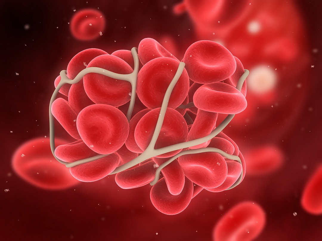 En pratique clinique, une thrombolyse -qui va « lyser » ou désagréger les thrombus ou caillots sanguins- est réalisée lorsque ces caillots formés dans des vaisseaux sanguins menacent la vie du patient. 