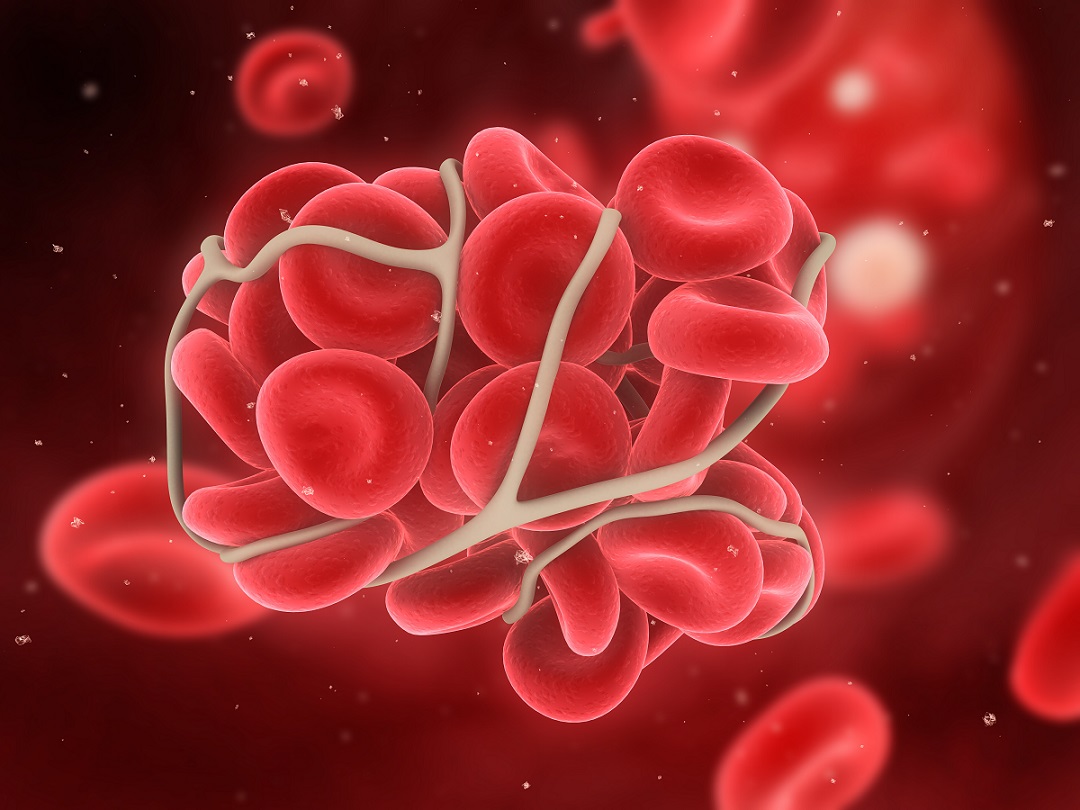 En pratique clinique, une thrombolyse -qui va « lyser » ou désagréger les thrombus ou caillots sanguins- est réalisée lorsque ces caillots formés dans des vaisseaux sanguins menacent la vie du patient. En pratique clinique, une thrombolyse -qui va « lyser » ou désagréger les thrombus ou caillots sanguins- est réalisée lorsque ces caillots formés dans des vaisseaux sanguins menacent la vie du patient.