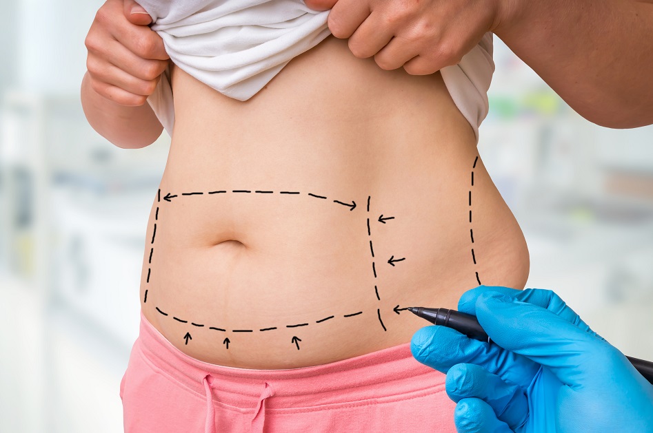 Ce bilan d’experts en chirurgie esthétique révèle de nouvelles tendances en matière d'abdominoplastie (Visuel Adobe Stock 219739310)