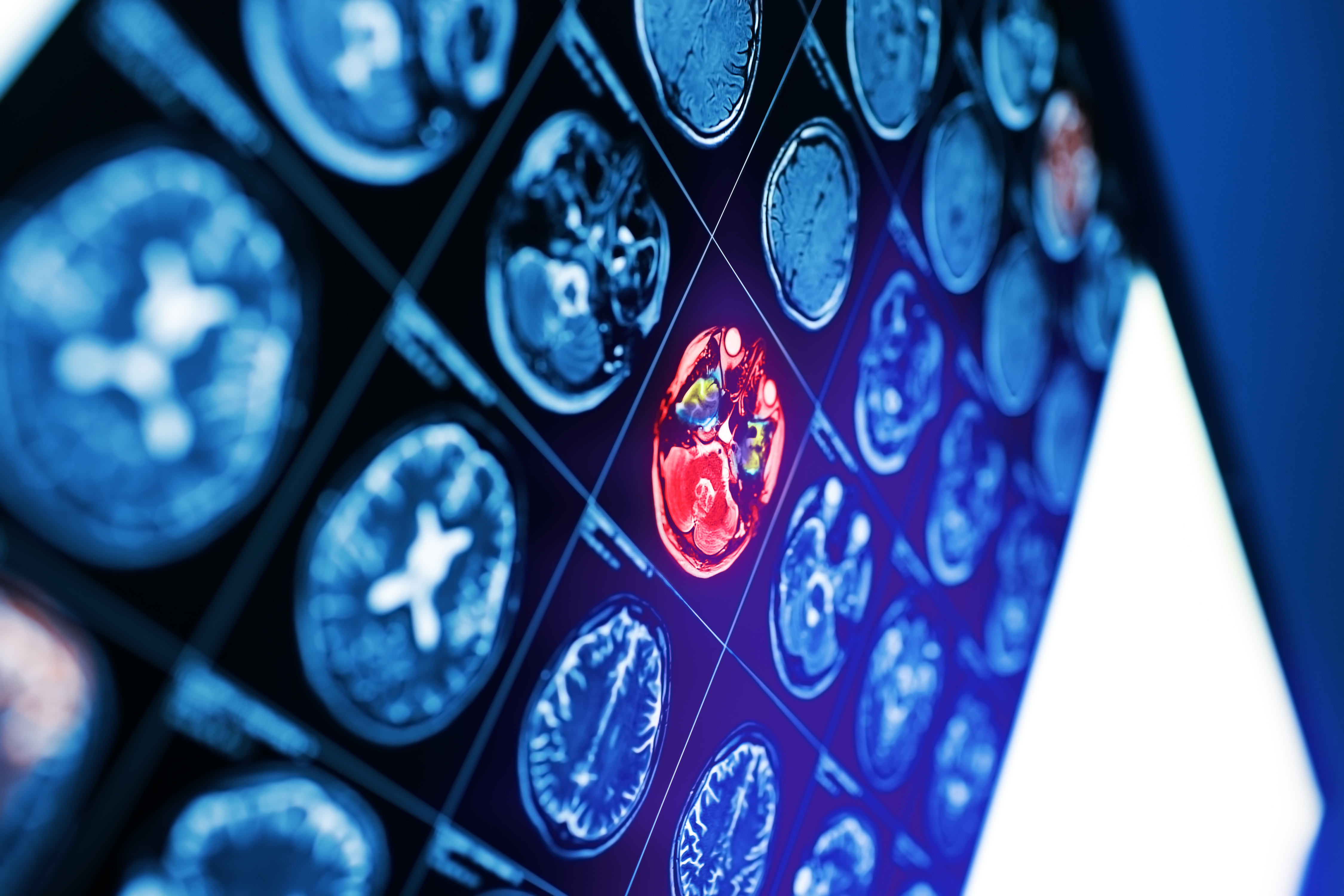 Ce nouvel outil diagnostique permet de détecter les problèmes de circulation sanguine dans les capillaires cérébraux, caractéristiques de différents troubles neurologiques (Visuel Adobe Stock 220113313) 