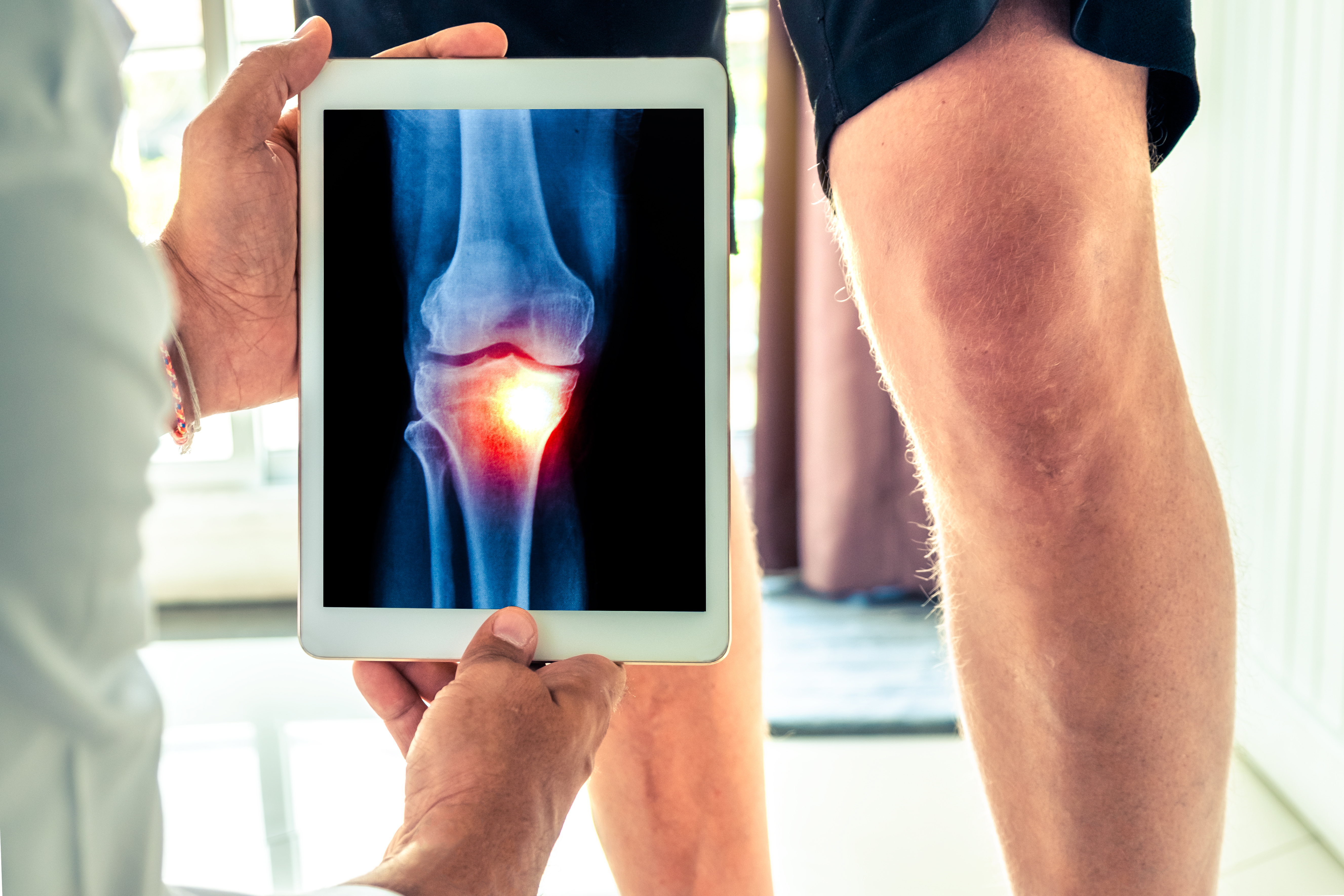 Ce traitement non chirurgical réduit la douleur au genou chez les adultes, en particulier ceux de 50 ans et plus et contribue à une amélioration considérable de la qualité de vie (Visuel Adobe Stock 235689003) 