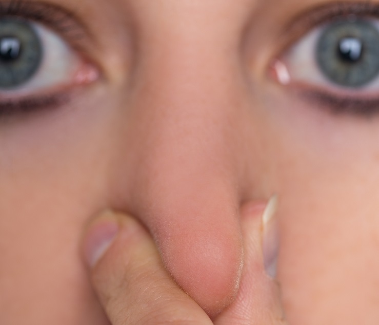 La perte d'odorat est signalée par les patients dans 86% des cas légers de COVID-19 (Visuel Adobe Stock 257463391) La perte d'odorat est signalée par les patients dans 86% des cas légers de COVID-19 (Visuel Adobe Stock 257463391)
