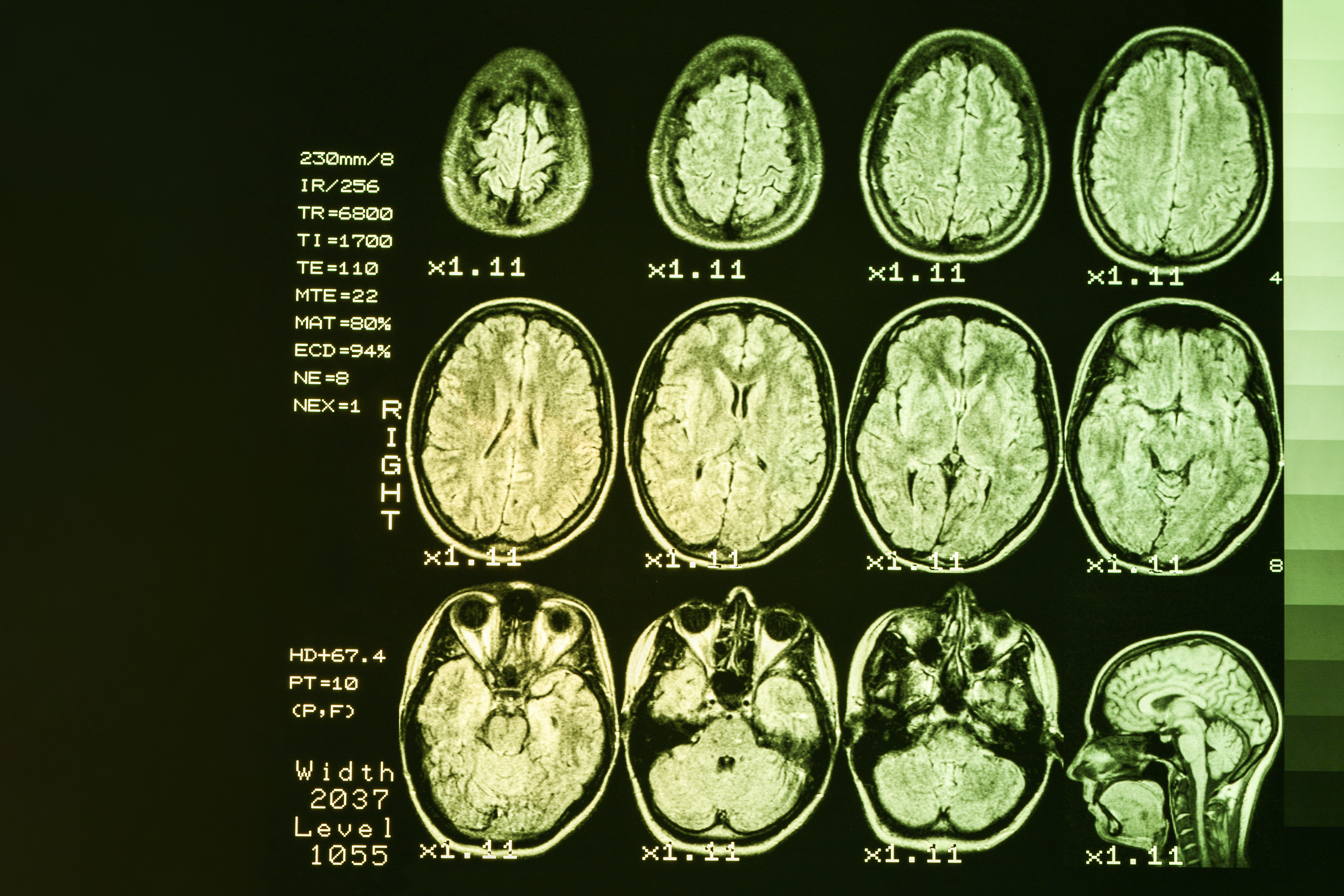 La perturbation de l'autophagie, un mécanisme de dégradation et d'élimination du matériel cellulaire obsolète, pourrait être à l'origine de changements cognitifs précoces dans la maladie de Huntington (Visuel Adobe Stock 266839758)