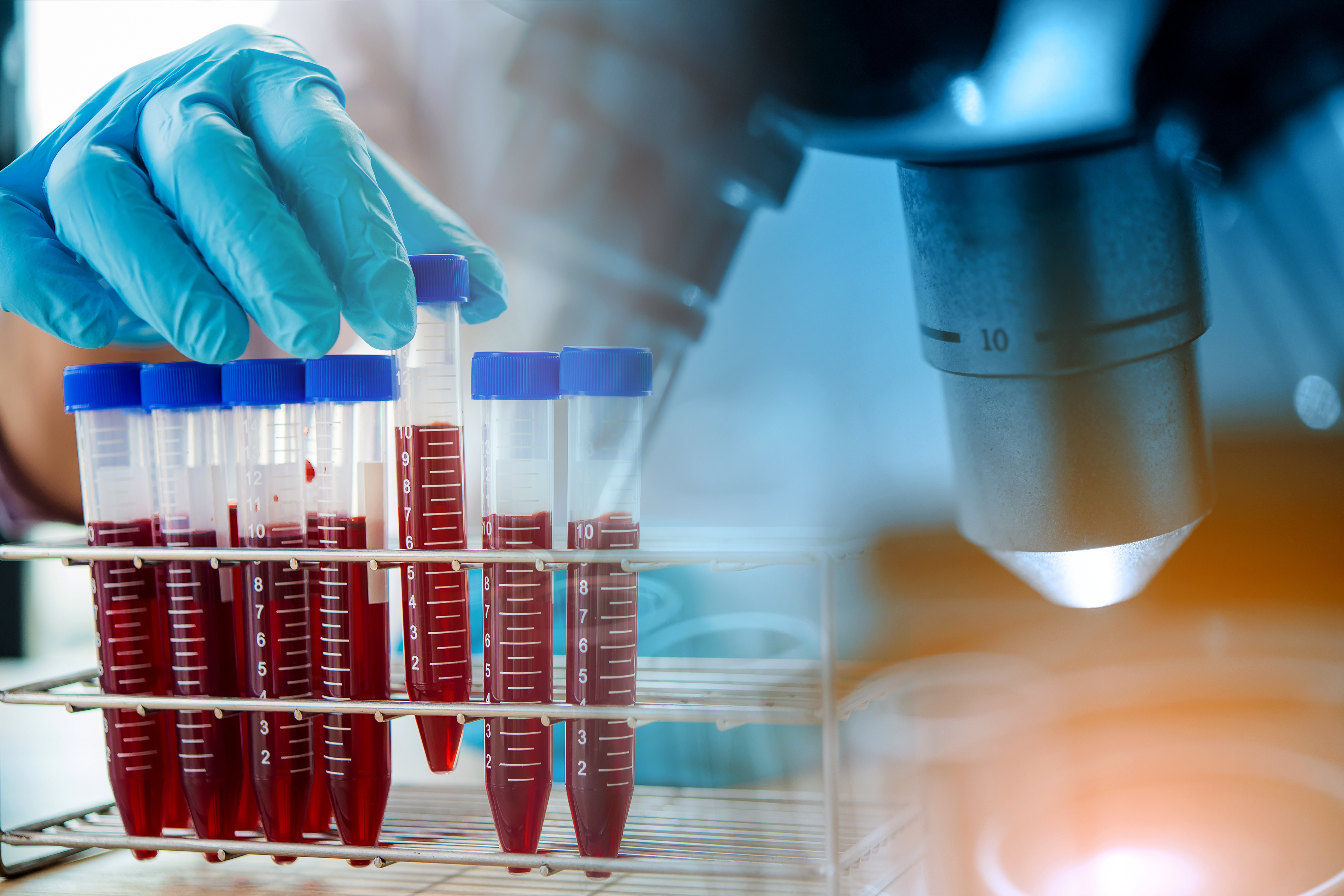 Ce nouveau test sanguin démontre une très grande précision pour détecter la maladie d’Alzheimer (Visuel Adobe Stock 283646387) Ce nouveau test sanguin démontre une très grande précision pour détecter la maladie d’Alzheimer (Visuel Adobe Stock 283646387)