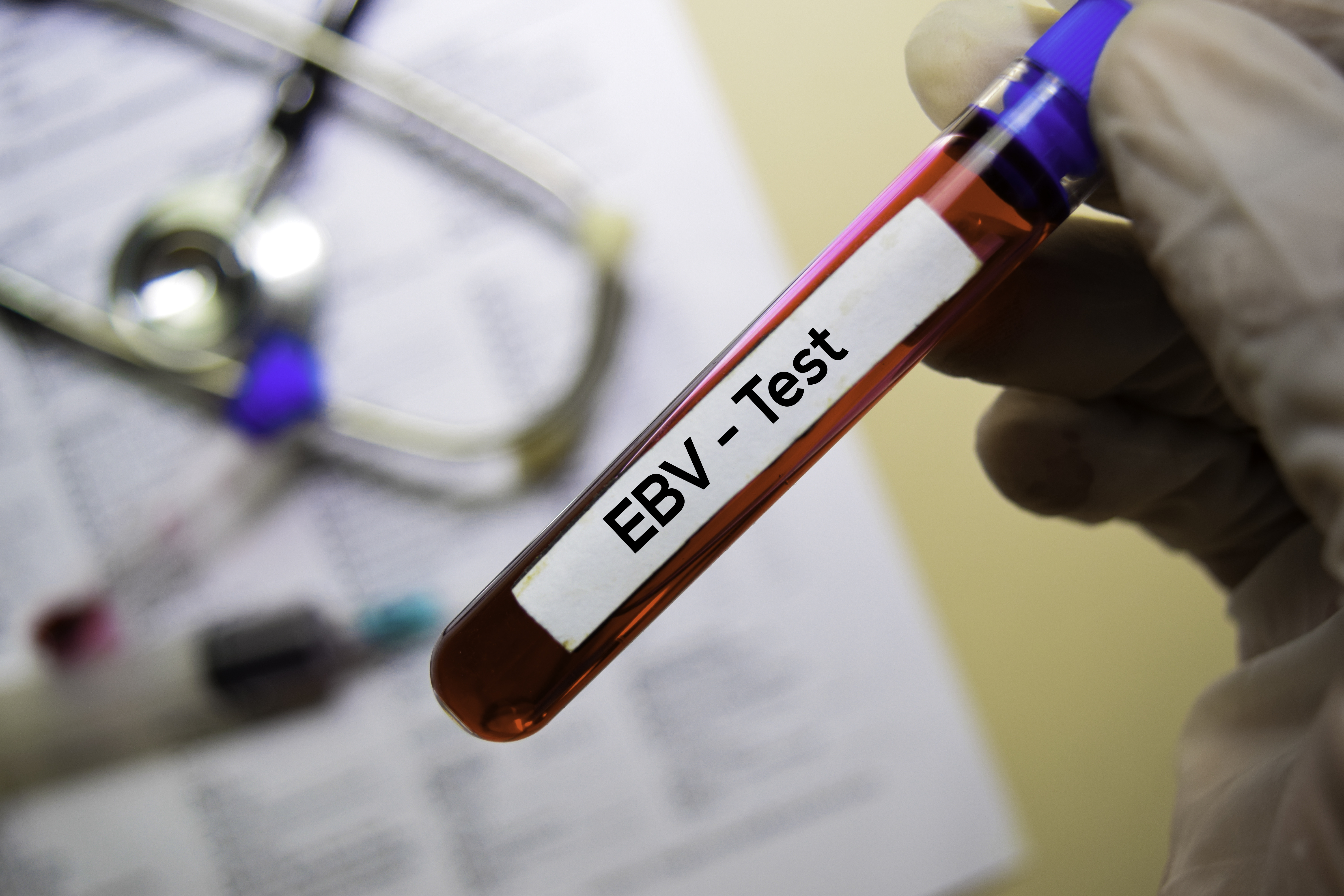 Ces symptômes durables du COVID long sont très probablement causés par la réactivation du virus d'Epstein-Barr (EBV) liée à la réponse inflammatoire à l'infection à SARS-CoV-2, conclut cette équipe américaine (Visuel Adobe Stock 287154516) Ces symptômes durables du COVID long sont très probablement causés par la réactivation du virus d'Epstein-Barr (EBV) liée à la réponse inflammatoire à l'infection à SARS-CoV-2, conclut cette équipe américaine (Visuel Adobe Stock 287154516)