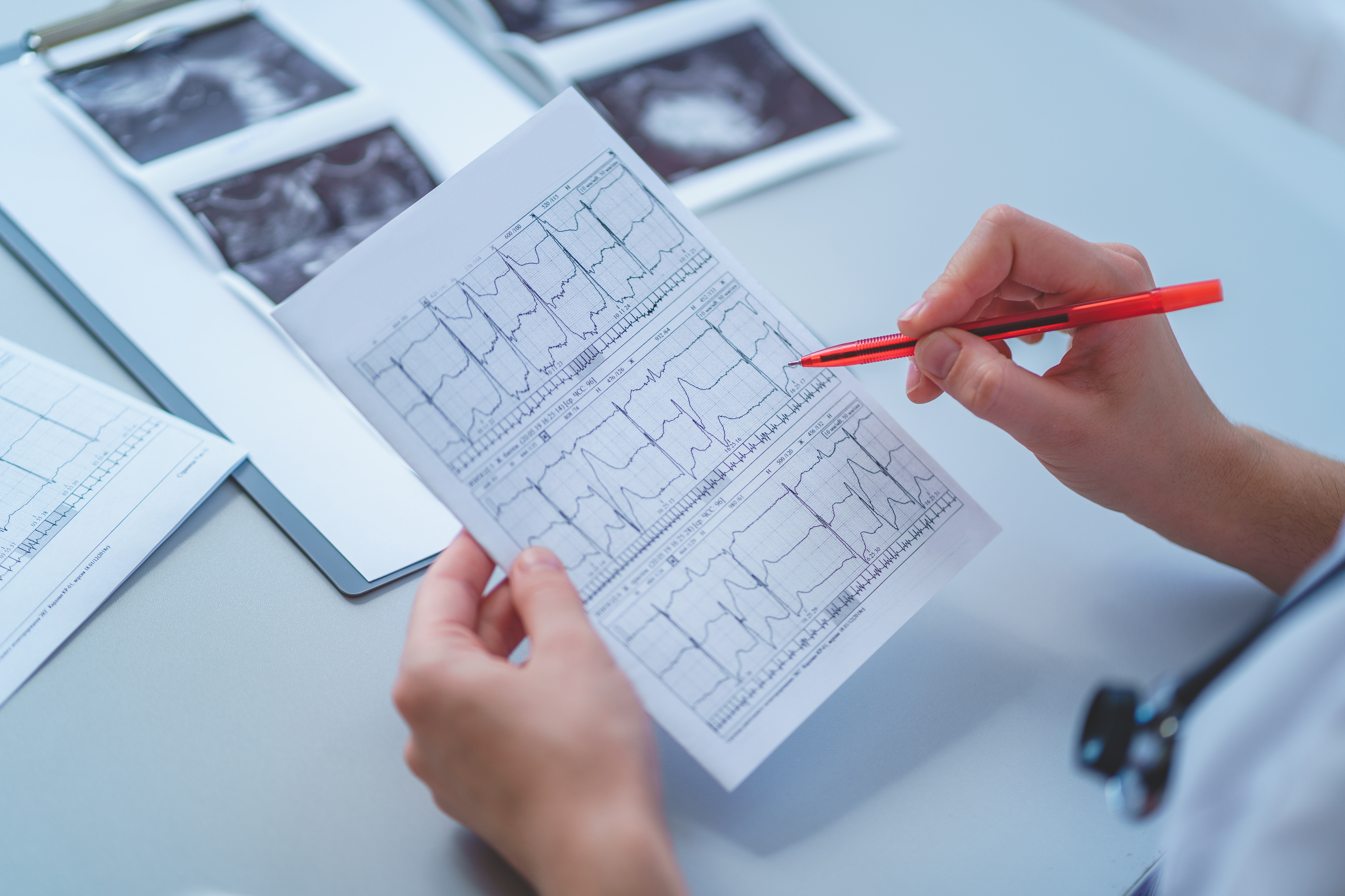 Le nouveau système basé sur l’apprentissage automatique et les lectures d'électrocardiogramme (ECG) permet en effet de diagnostiquer et de caractériser les crises cardiaques plus rapidement et plus précisément que les approches standards actuelles (Visuel Adobe Stock 289339079)