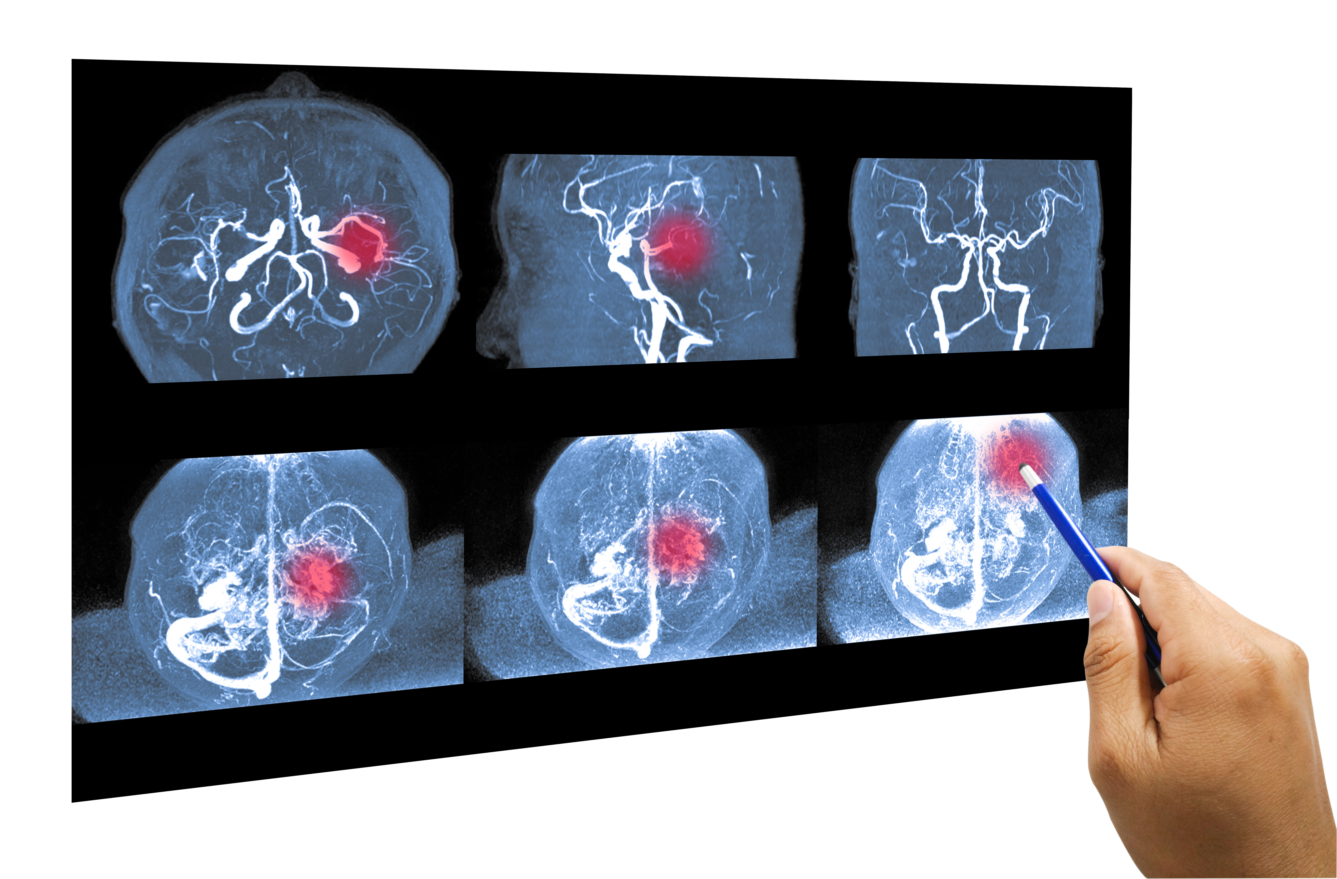 De mêmes gènes pourraient être à l'origine des maladies cardiométaboliques et de la démence (Visuel Adobe Stock 292919746) De mêmes gènes pourraient être à l'origine des maladies cardiométaboliques et de la démence (Visuel Adobe Stock 292919746)