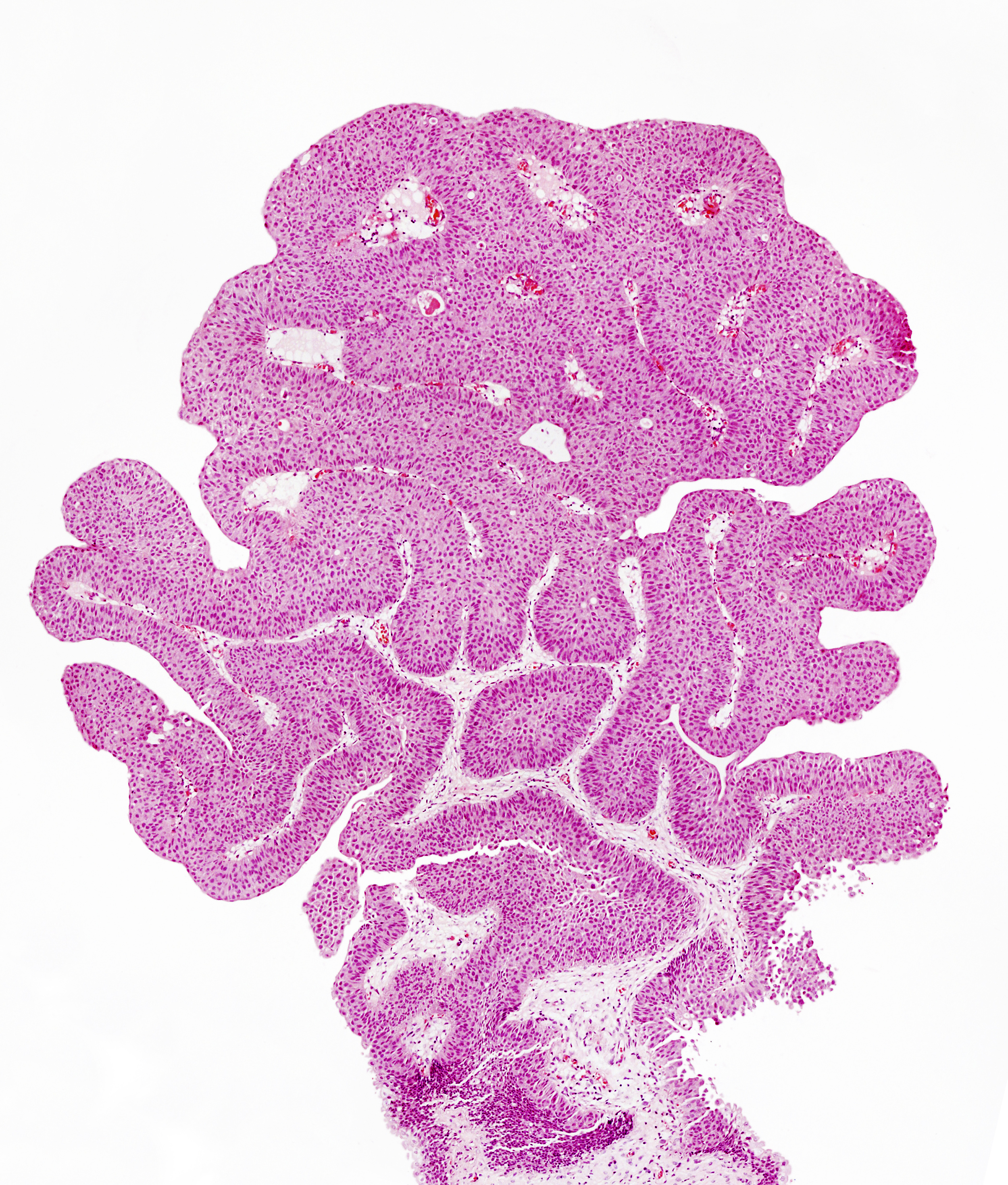 Chaque année dans le monde, on recense environ 549.000 nouveaux cas et 200.000 décès de cancer de la vessie (Visuel Adobe Stock 29642937). 