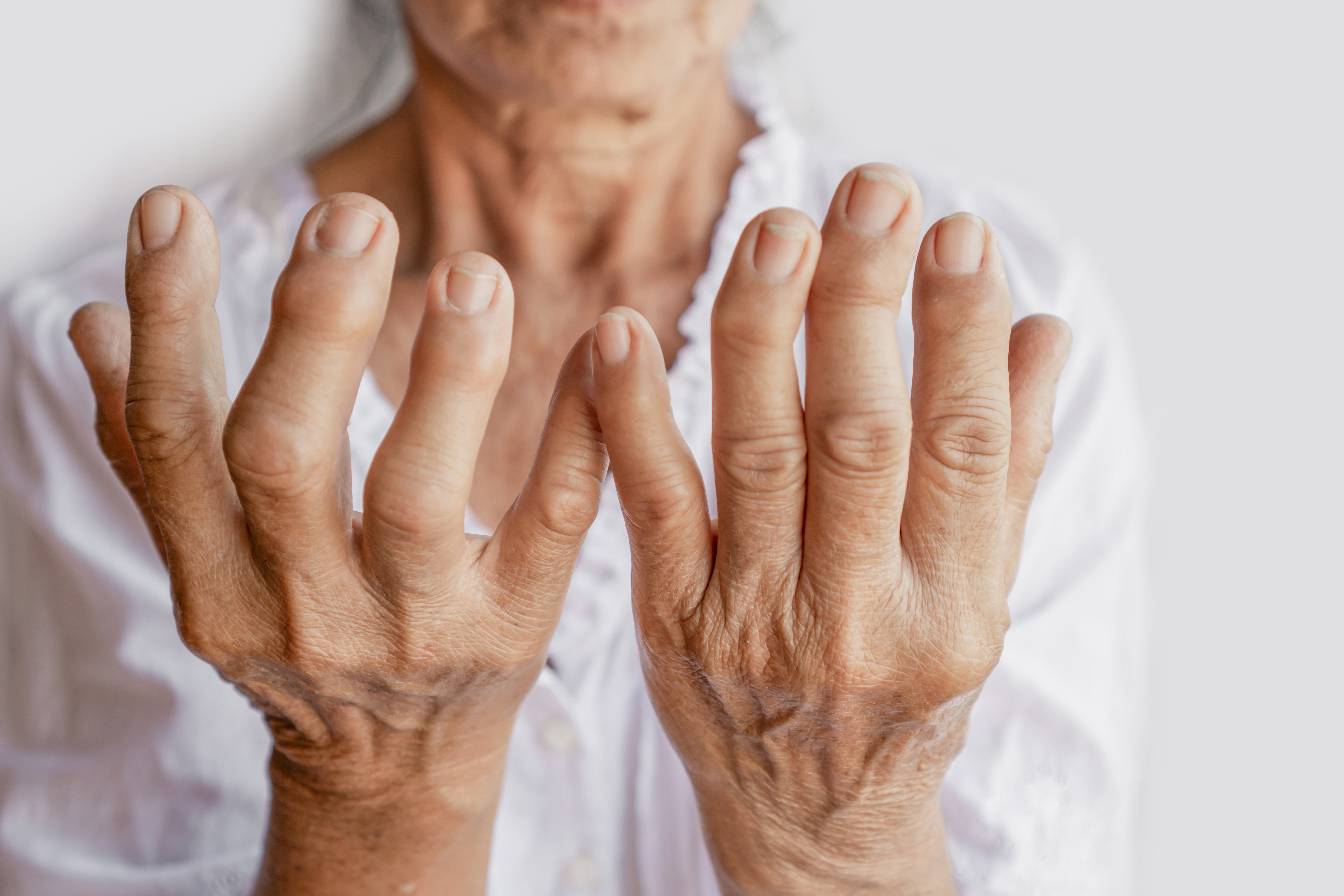 Ce nouveau médicament non seulement supprime l'inflammation, mais réduit également considérablement les scores de douleur rapportés par les patients (Visuel Adobe Stock 304058462)