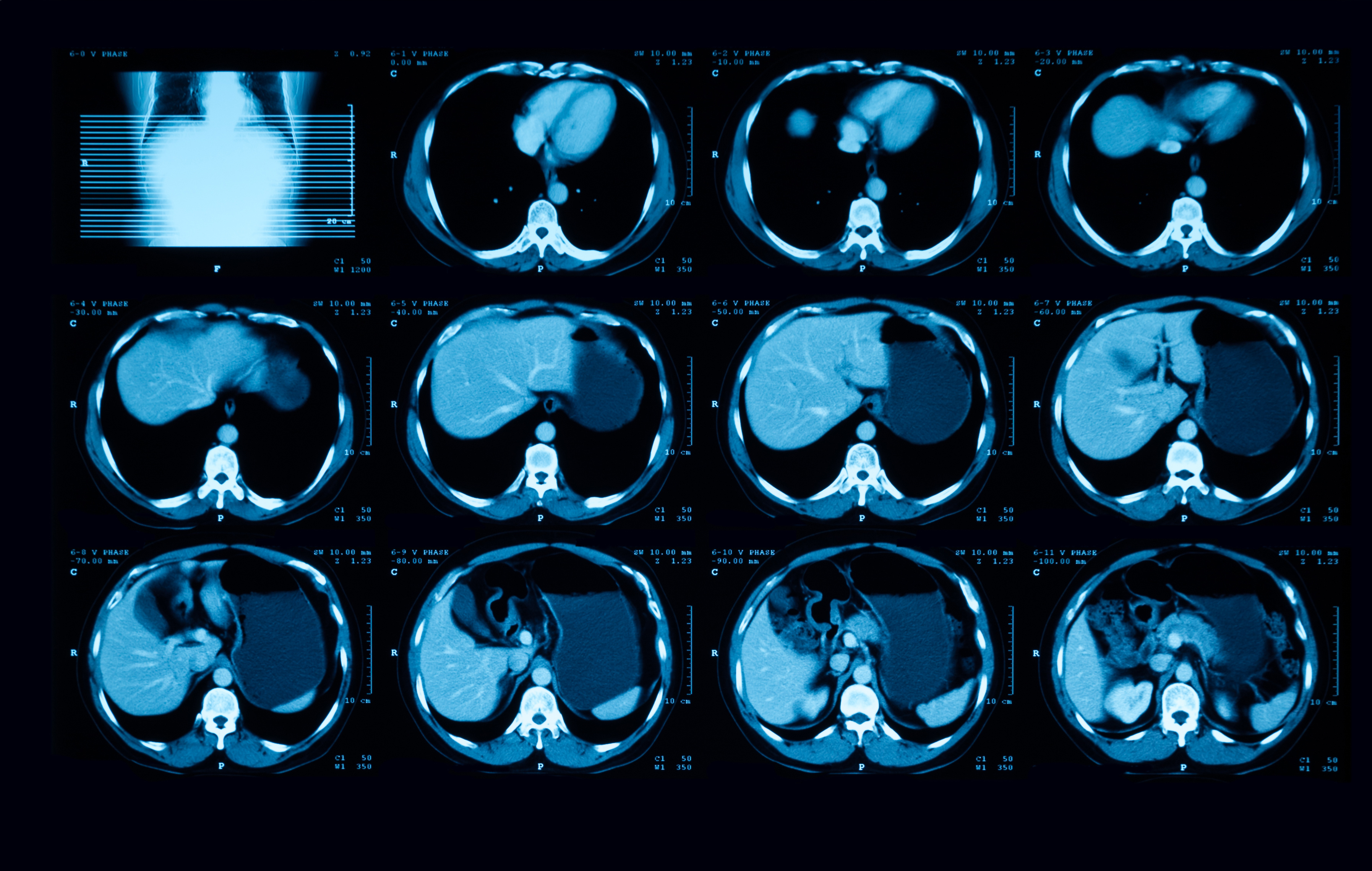 Cette étude documente une nouvelle option thérapeutique prometteuse pour les patients atteints d'un cancer urothélial avancé (Visuel Adobe Stock 308601417)