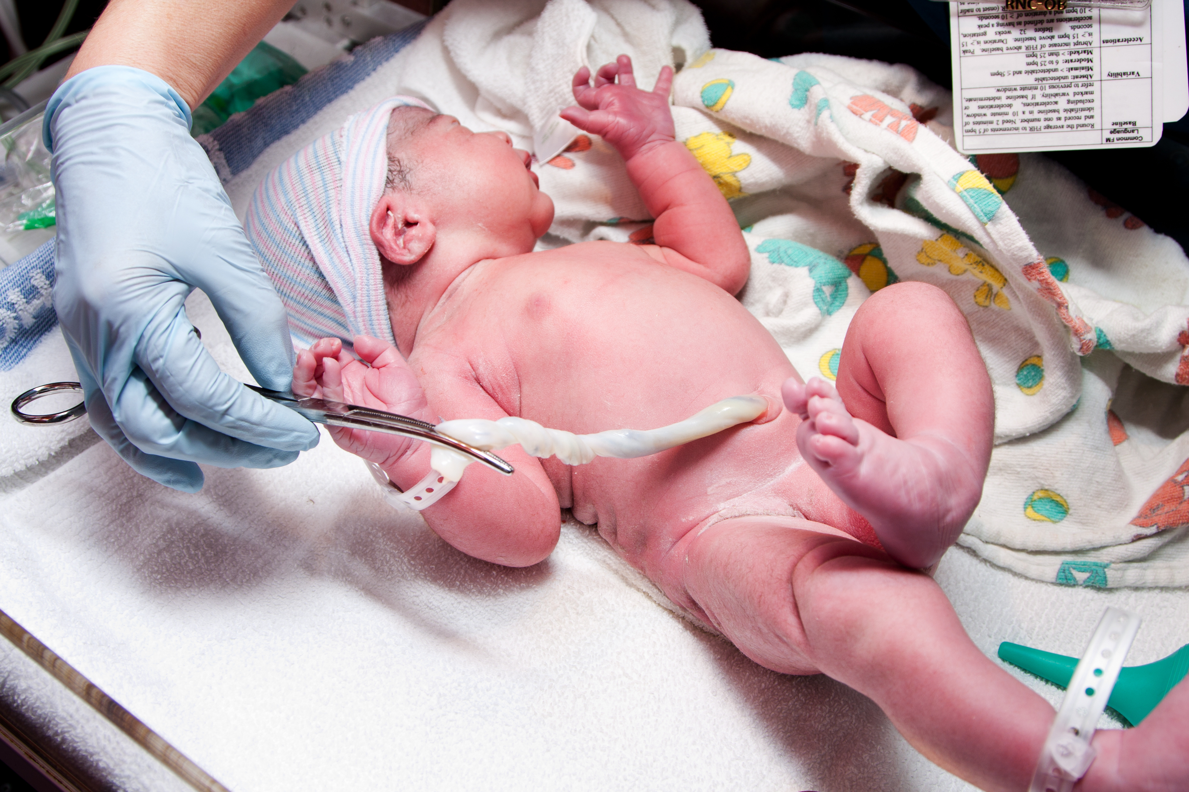 Cette large étude apporte les preuves d’efficacité de la technique consistant à retarder le clampage du cordon ombilical, pour optimiser les résultats de santé et la survie des bébés prématurés (Visuel Adobe Stock 37666907)