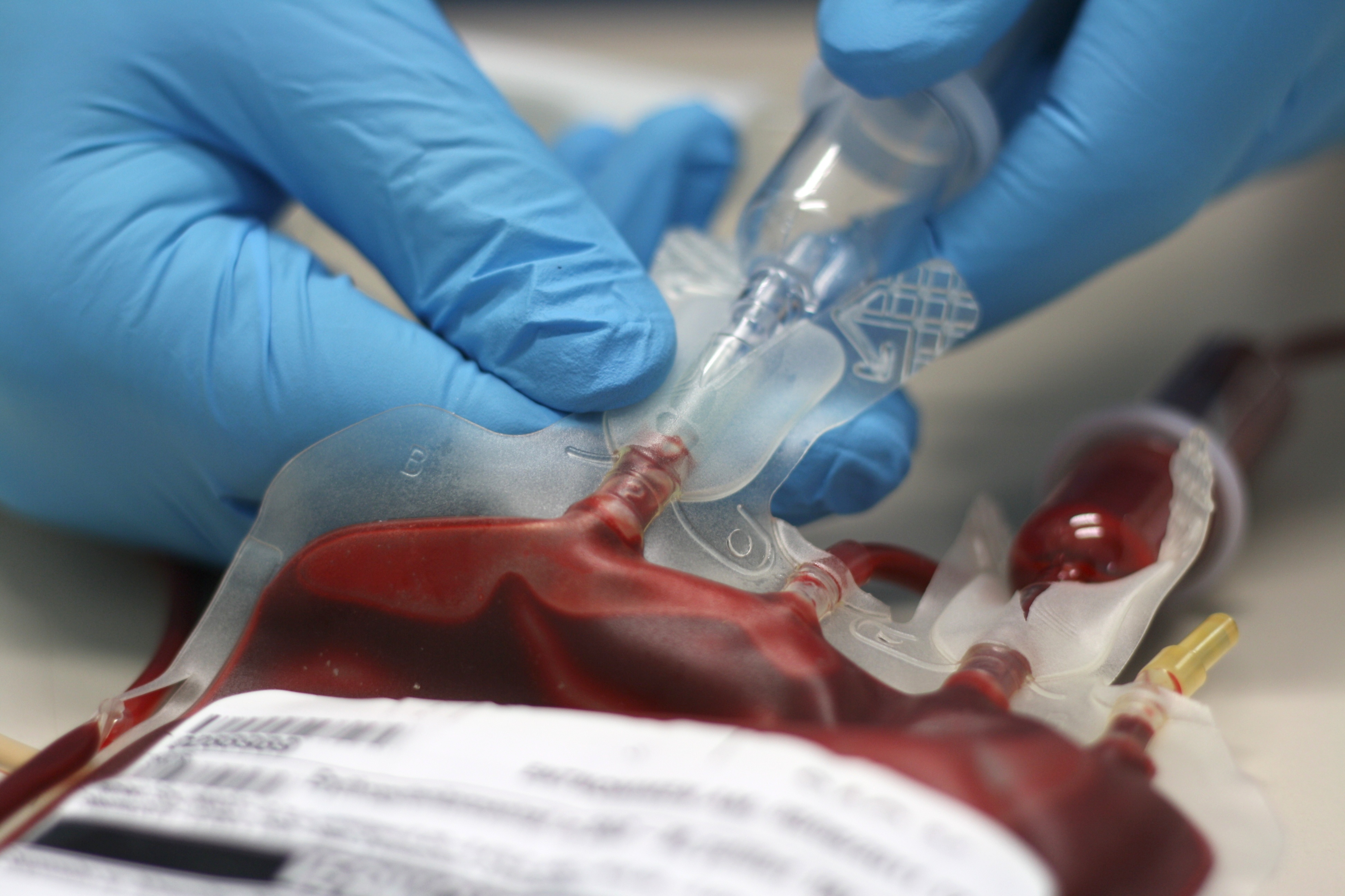 L'échange de sang total -ou exsanguino-transfusion- constituerait-il une nouvelle option de traitement de la maladie d'Alzheimer ? (Visuel Adobe Stock  42002934)