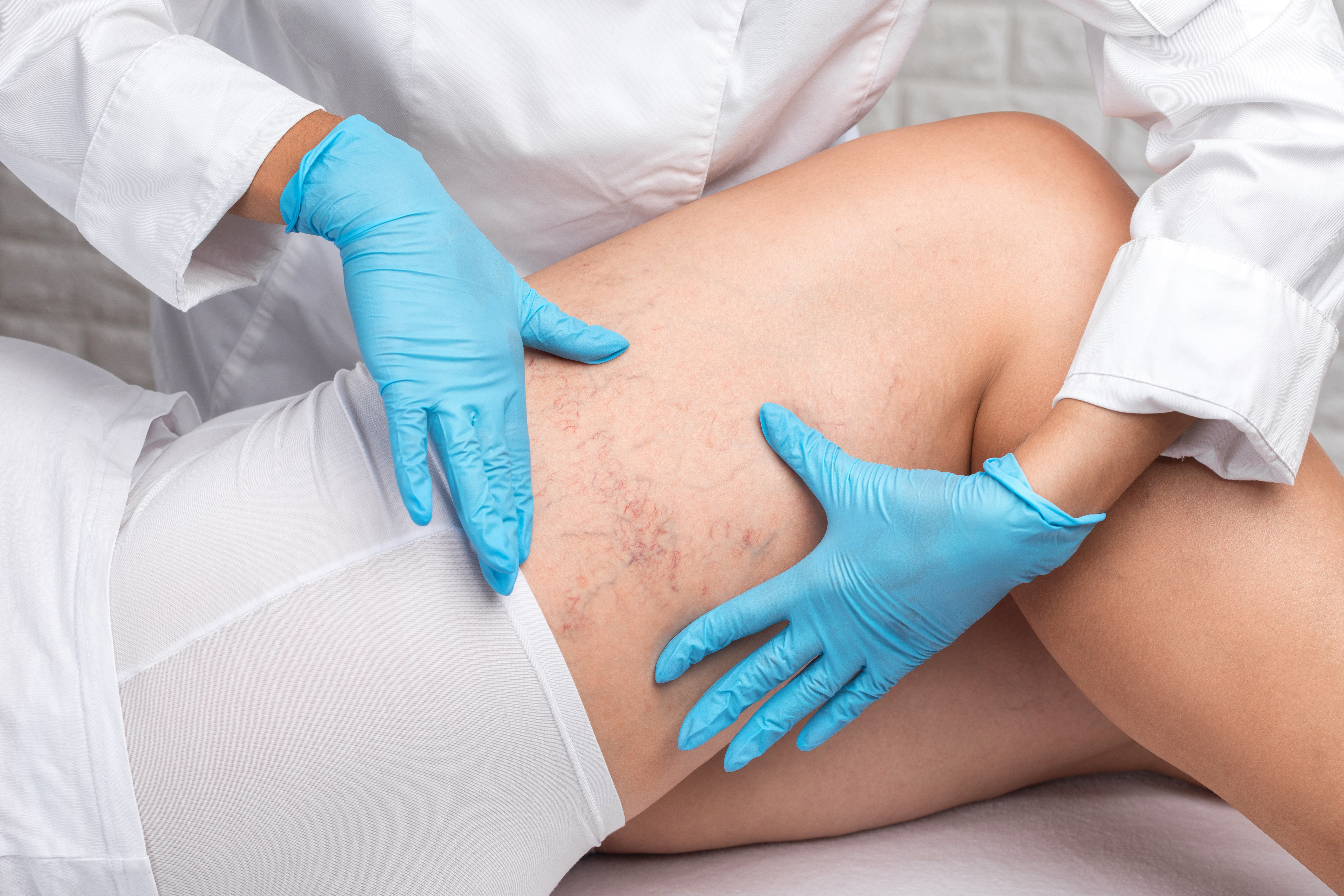 Les hommes atteints d'un cancer de la prostate ont un risque plus élevé, et de 50 % en moyenne, de caillots sanguins graves (Visuel Adobe Stock 461776337) Les hommes atteints d'un cancer de la prostate ont un risque plus élevé, et de 50 % en moyenne, de caillots sanguins graves (Visuel Adobe Stock 461776337)