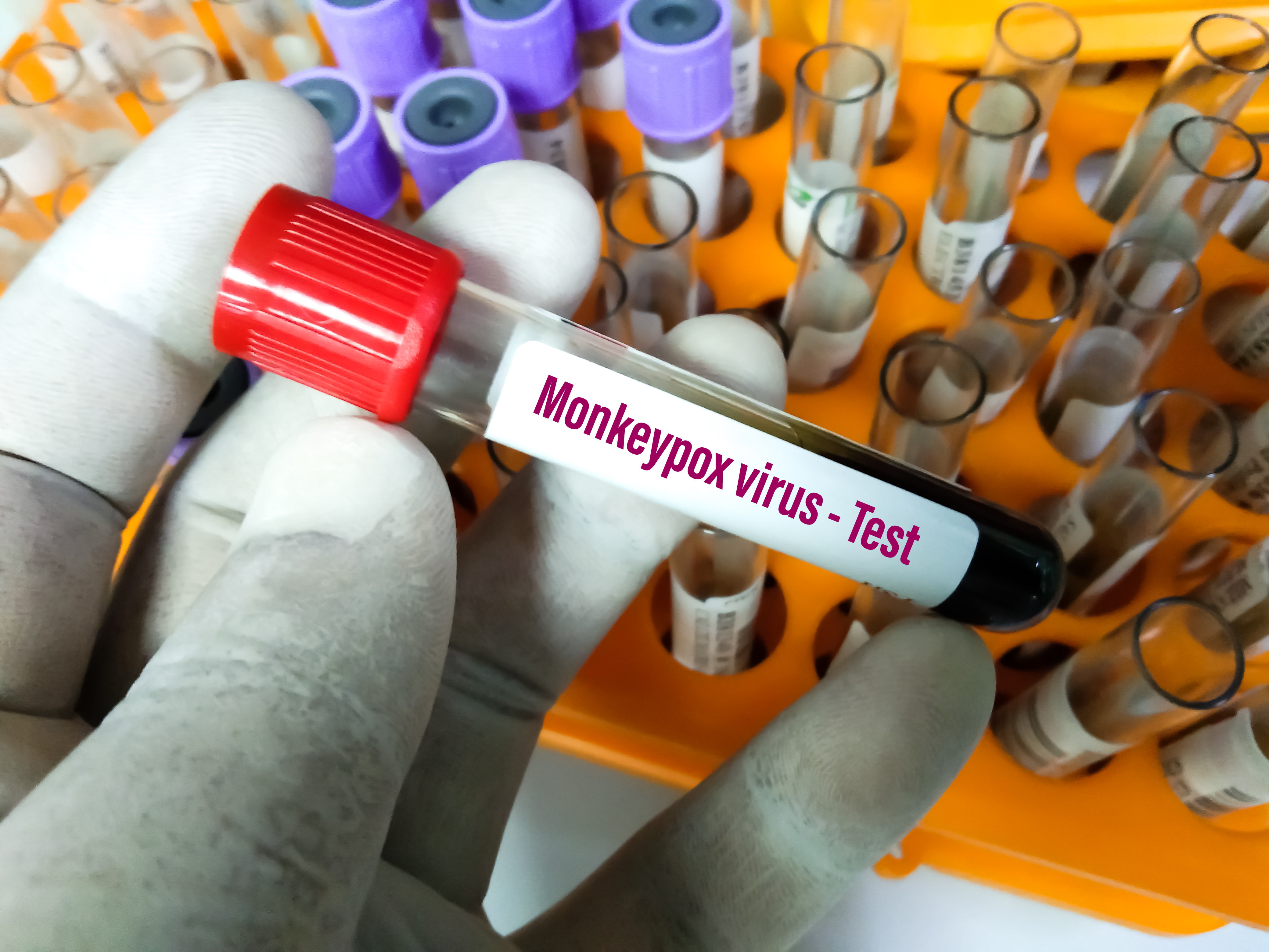 Un point sur les changements cutanés observés dans l’épidémie actuelle de variole du singe ou « monkeypox » (Visuel Adobe Stock 505799030) Un point sur les changements cutanés observés dans l’épidémie actuelle de variole du singe ou « monkeypox » (Visuel Adobe Stock 505799030)