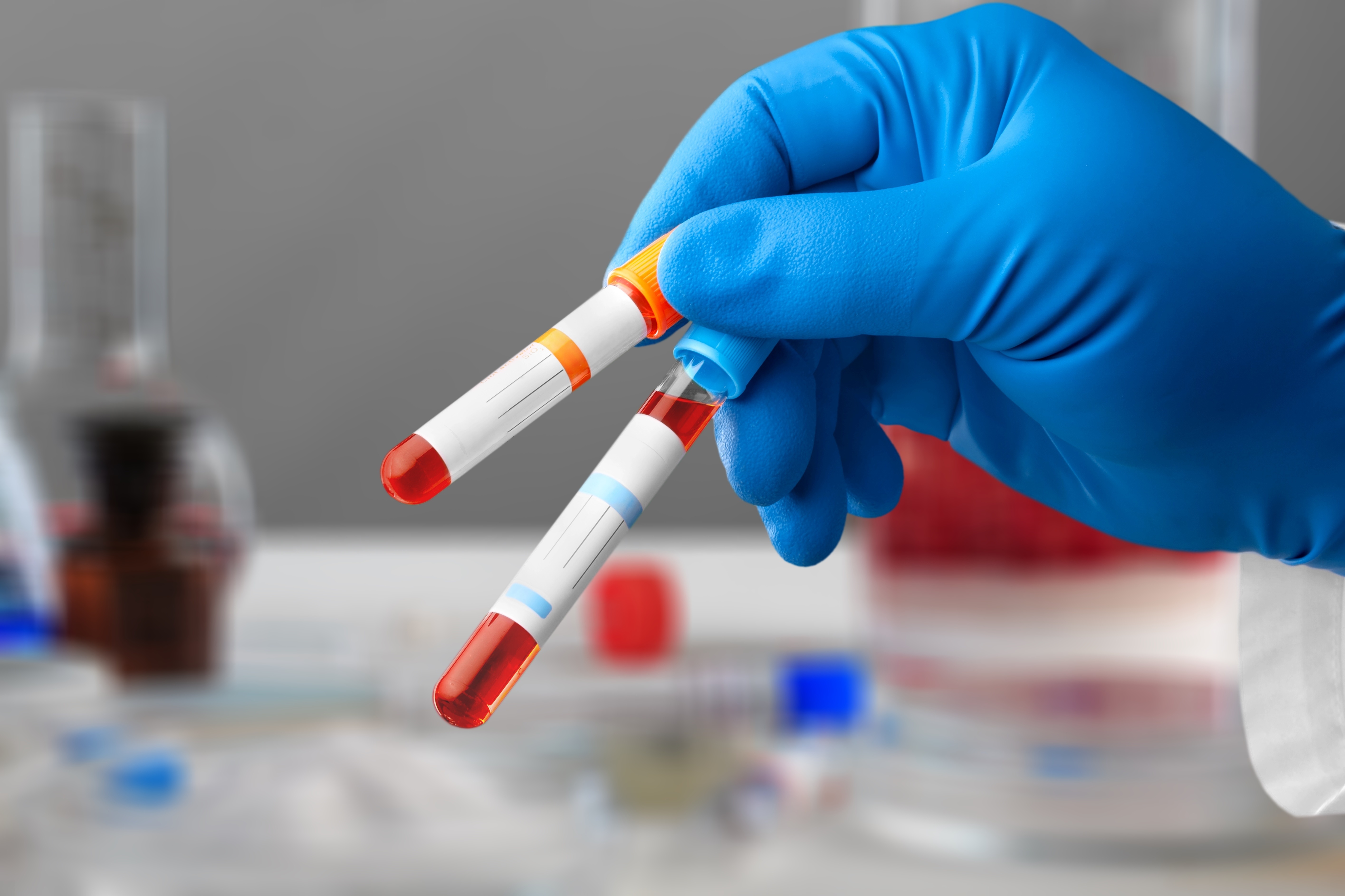 Ce nouveau test sanguin, basé sur l'analyse des modifications de l'ADN dans le sang et développé à l’Université d'Édimbourg pourrait aider à identifier le risque de diabète de type 2 …à 10 ans (Visuel Adobe Stock 515064482)