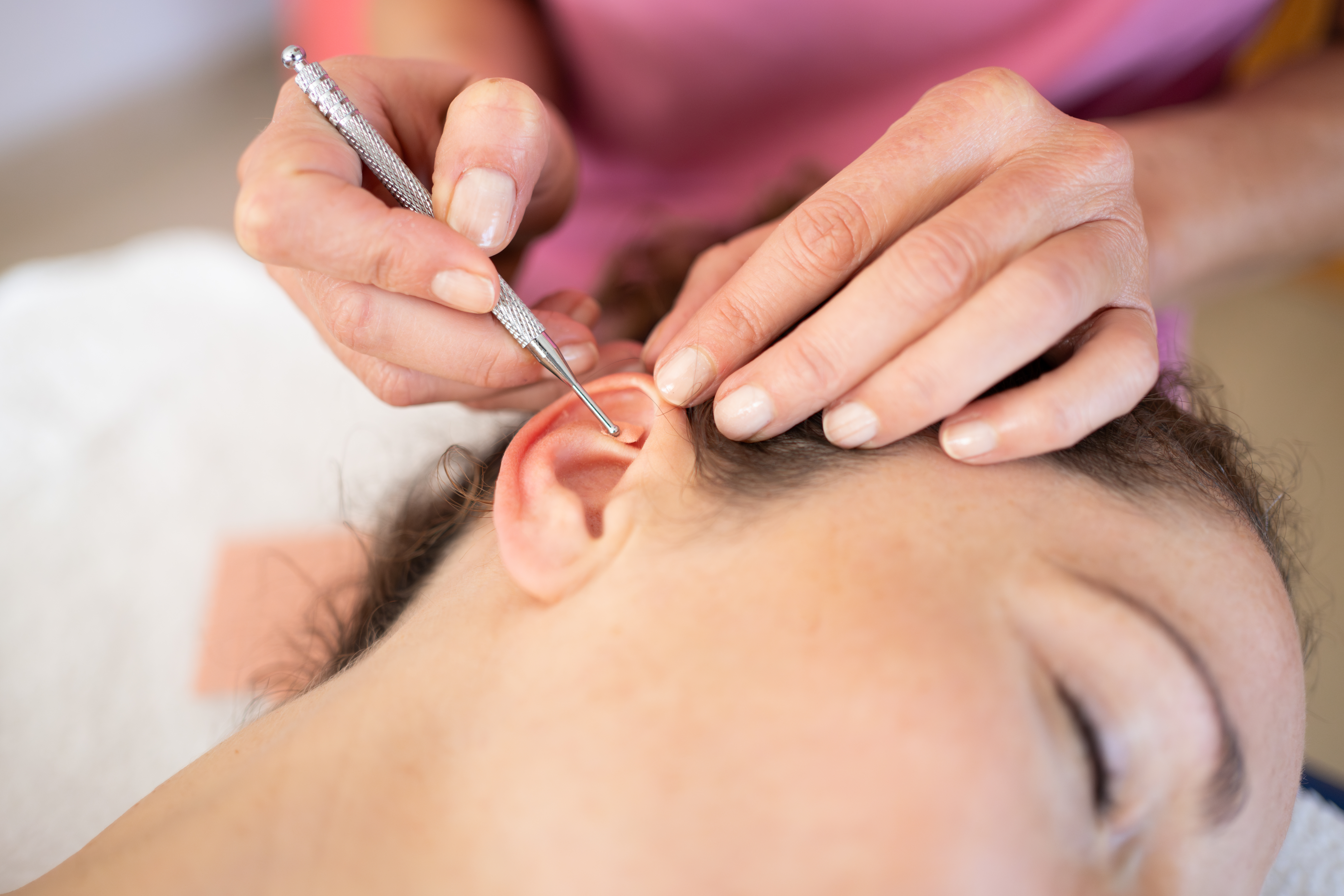 L'auriculoth&eacute;rapie, une forme d&rsquo;acupuncture &agrave; des points sp&eacute;cifiques de l'oreille, r&eacute;duit la douleur de migraine d'environ 18 % &agrave; 30 jours vs la ligne de base (Visuel Adobe stock 704303252)