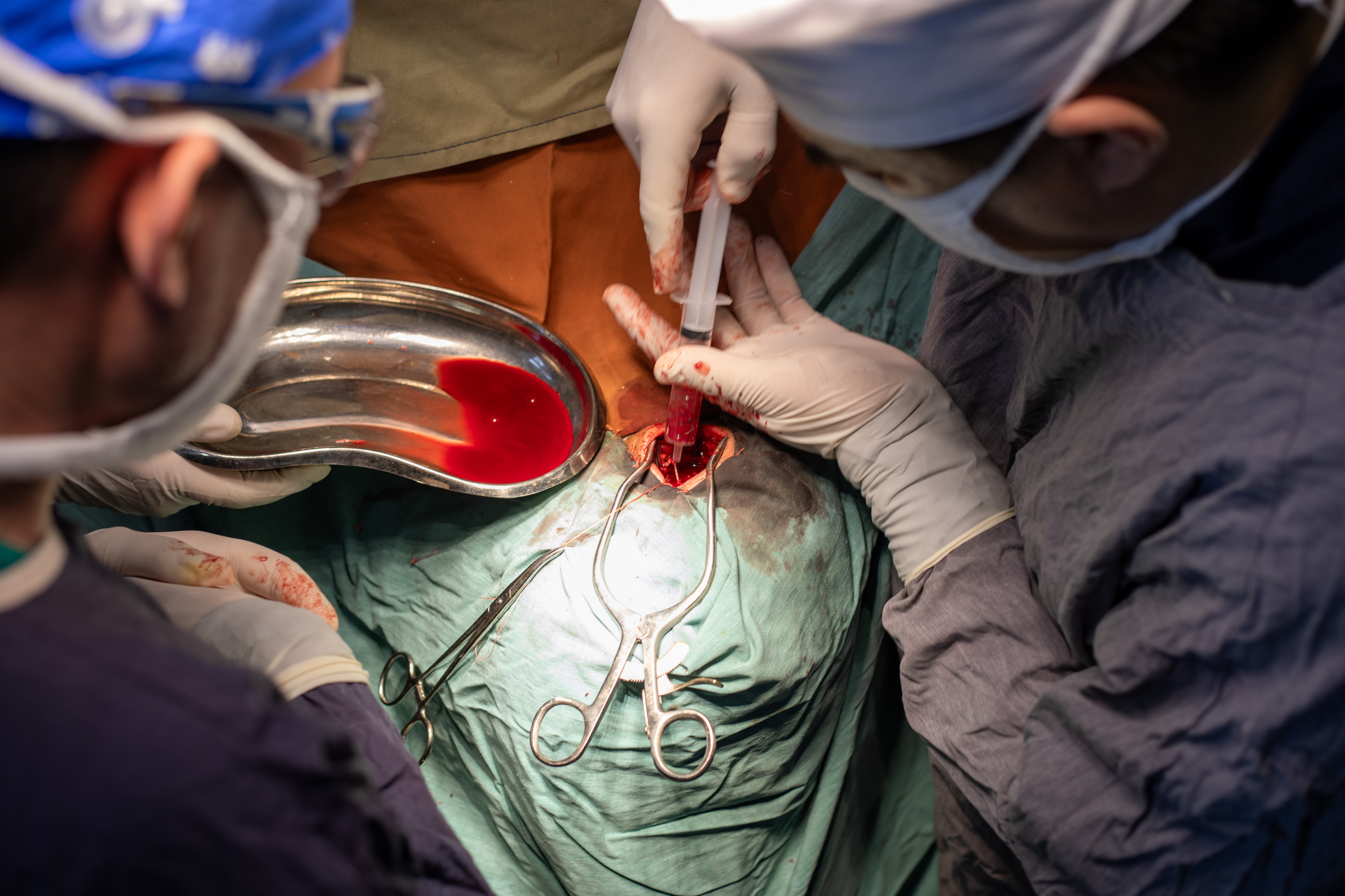 Combiner une chirurgie et l’embolisation pour traiter les hématomes sous-duraux réduit le risque de récidive et de nouvelle chirurgie (Visuel Adobe Stock 752345247) Combiner une chirurgie et l’embolisation pour traiter les hématomes sous-duraux réduit le risque de récidive et de nouvelle chirurgie (Visuel Adobe Stock 752345247)
