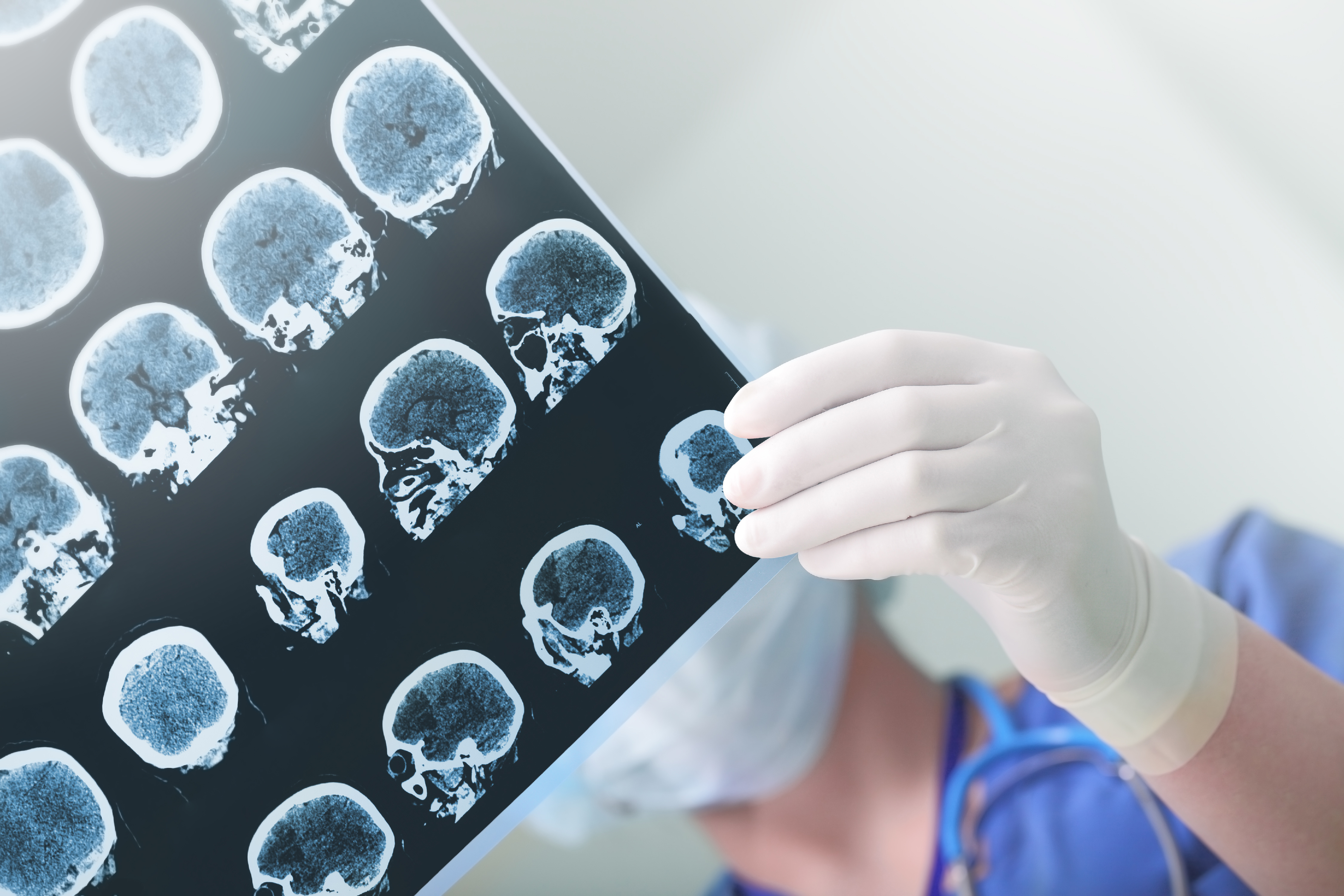 L'épilepsie est un trouble neurologique caractérisé par une activité cérébrale anormale qui peut provoquer des crises, et qui touche environ 1% de la population. L'épilepsie est un trouble neurologique caractérisé par une activité cérébrale anormale qui peut provoquer des crises, et qui touche environ 1% de la population.
