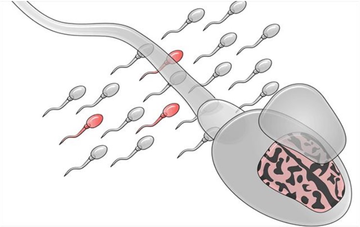 Pouvoir détecter certaines mutations dans le sperme du père pourrait permettre de révéler un risque d'autisme chez ses futurs enfants