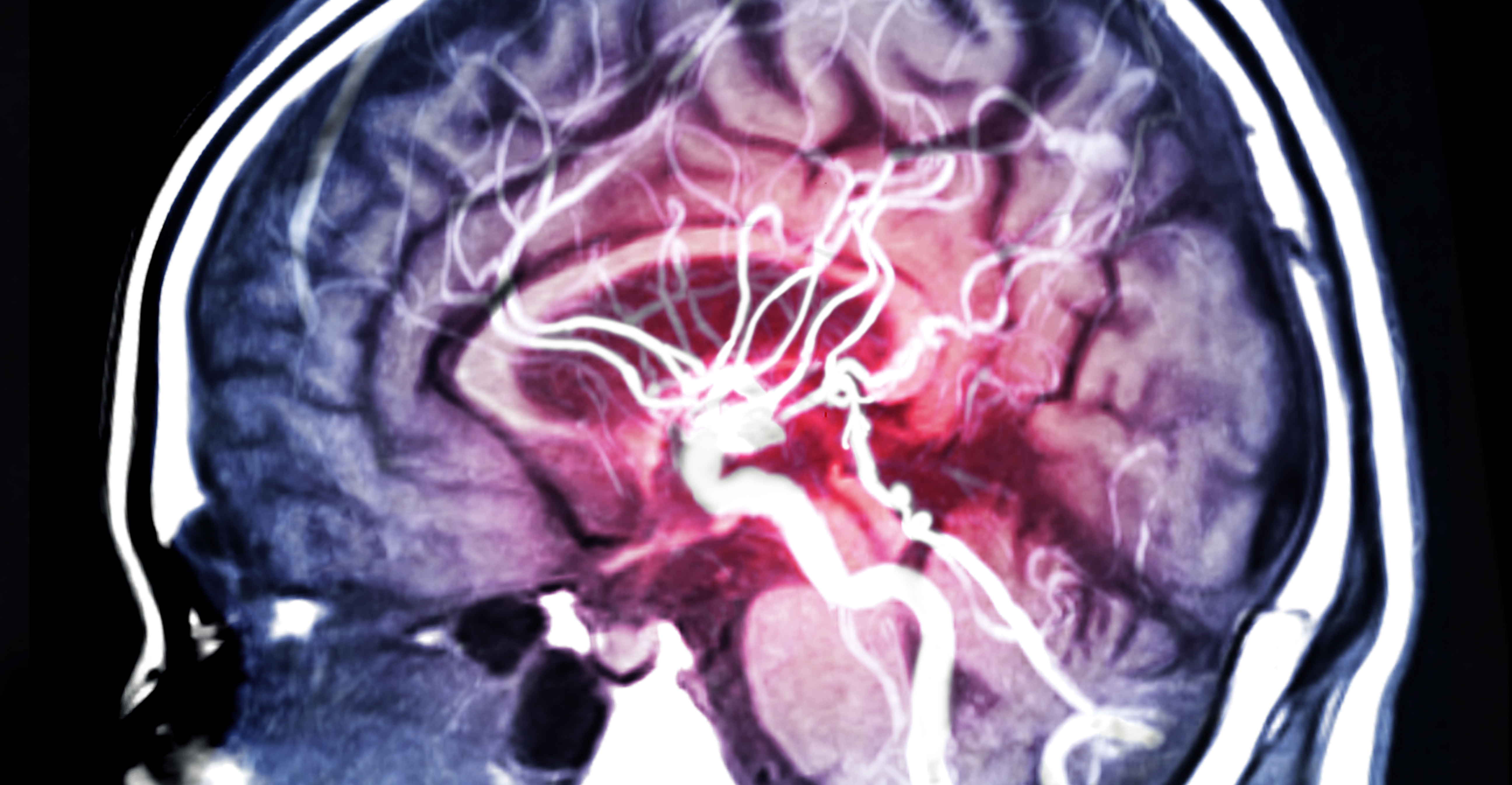 Ce nouveau médicament neuroprotecteur, le nérinetide, pourrait être très utile en combinaison avec la thérapie endovasculaire de reperfusion après un AVC ischémique. Ce nouveau médicament neuroprotecteur, le nérinetide, pourrait être très utile en combinaison avec la thérapie endovasculaire de reperfusion après un AVC ischémique.