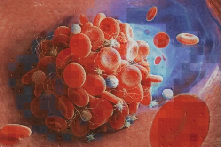  Différents types de caillots sanguins sont causés par différentes molécules, et les caillots ne se ressemblent pas tous (Visuel Yuqi Zhou (CC BY 4.0))