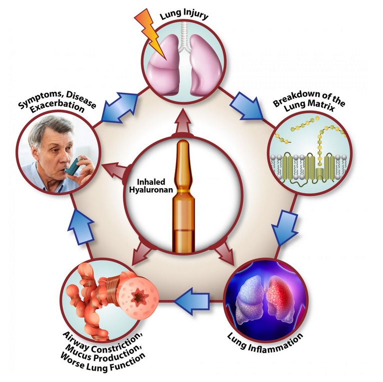 L'inhalation de hyaluronane interfère à presque toutes les étapes du cycle de la maladie pulmonaire (Voir visuel), ce qui en fait un traitement puissant pour les maladies pulmonaires chroniques (Visuel Stavros Garantziotis, M.D.). 