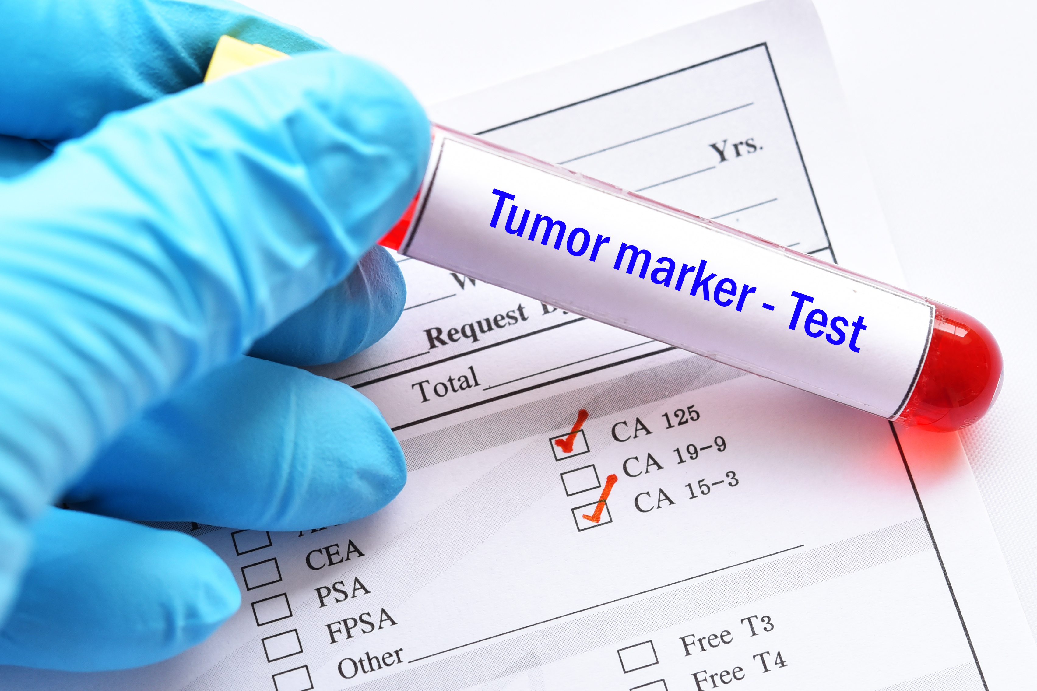 La baisse des niveaux de PSA prédit une survie plus longue chez les patients atteints d'un cancer de la prostate à risque élevé de métastases (Visuel Adobe Stock 217568322) La baisse des niveaux de PSA prédit une survie plus longue chez les patients atteints d'un cancer de la prostate à risque élevé de métastases (Visuel Adobe Stock 217568322)