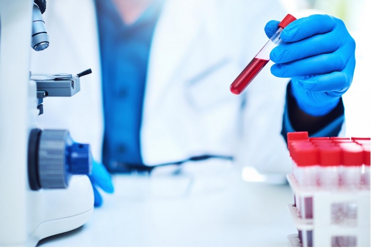 Ces travaux décrivent le développement d'un test sanguin, composé de biomarqueurs ARN, qui permet d’évaluer le degré de sévérité de la dépression, le risque d’aggravation, ainsi que le risque de trouble bipolaire futur (Visuel Fotolia) Ces travaux décrivent le développement d'un test sanguin, composé de biomarqueurs ARN, qui permet d’évaluer le degré de sévérité de la dépression, le risque d’aggravation, ainsi que le risque de trouble bipolaire futur (Visuel Fotolia)