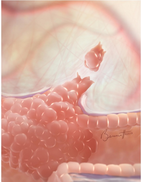 Lorsque les cellules quittent la tumeur primaire, elles ne répondent souvent plus aux médicaments qui ont initialement fonctionné (Visuel Fotolia)